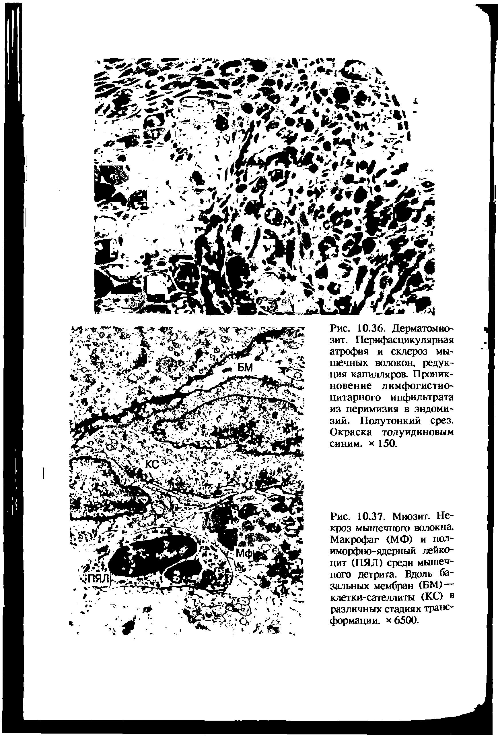 Рис. 10.37. Миозит. Некроз мышечного волокна. Макрофаг (МФ) и полиморфно-ядерный лейкоцит (ПЯЛ) среди мышечного детрита. Вдоль базальных мембран (БМ)— клетки-сателлиты (КС) в различных стадиях трансформации. х 6500.