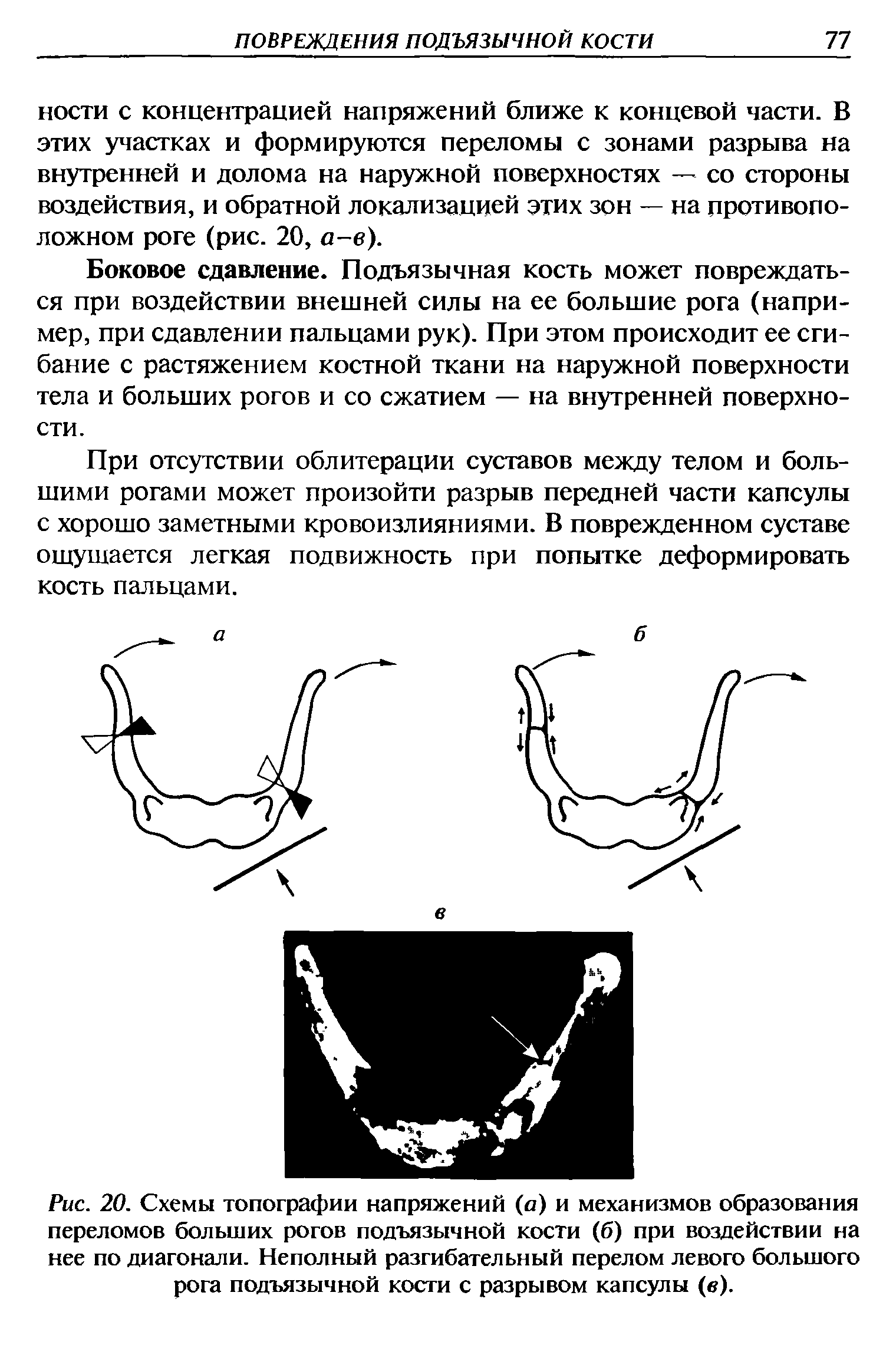 Рис. 20. Схемы топографии напряжений (о) и механизмов образования переломов больших рогов подъязычной кости (б) при воздействии на нее по диагонали. Неполный разгибательный перелом левого большого рога подъязычной кости с разрывом капсулы (в).