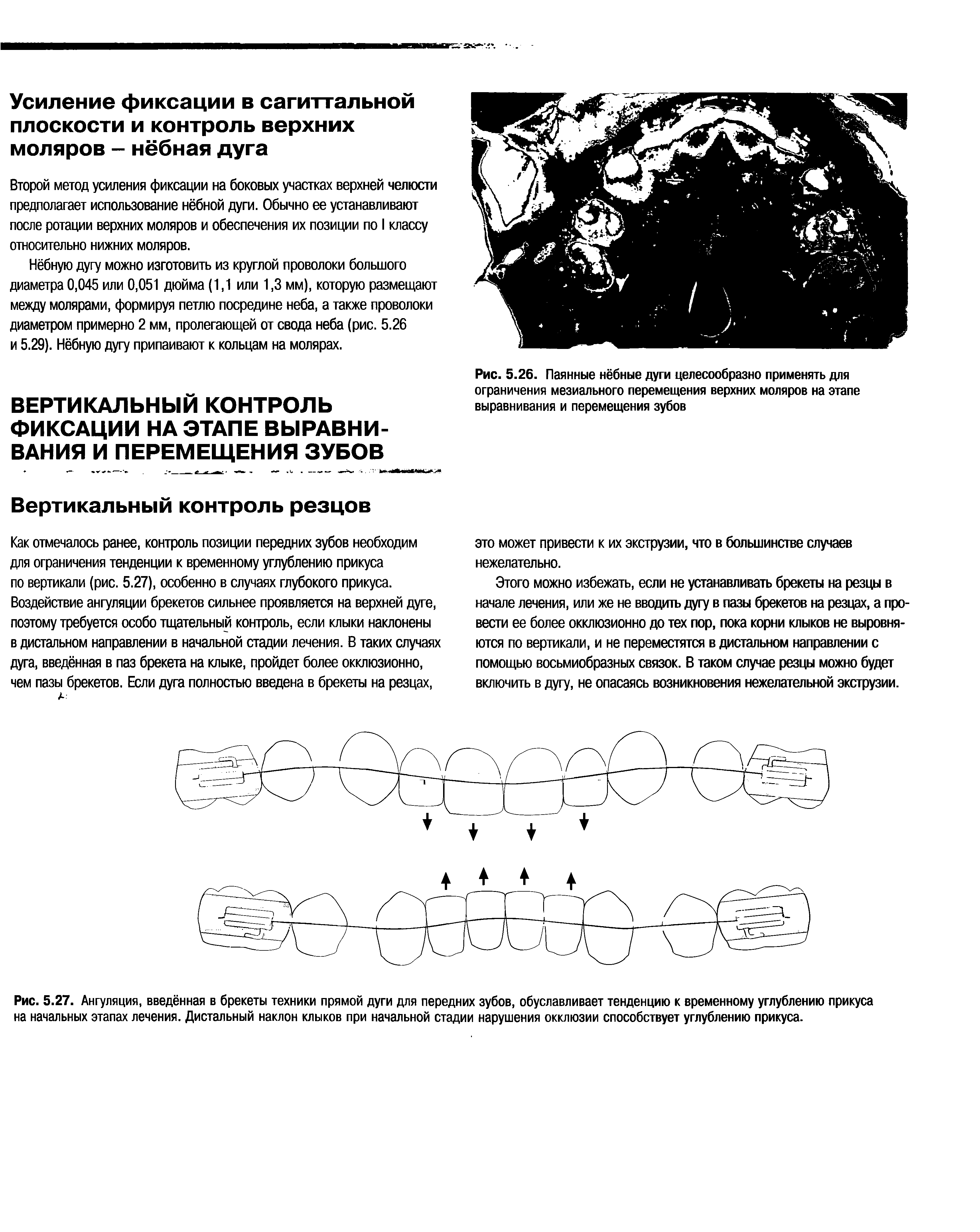 Рис. 5.26. Паянные нёбные дуги целесообразно применять для ограничения мезиального перемещения верхних моляров на этапе выравнивания и перемещения зубов...