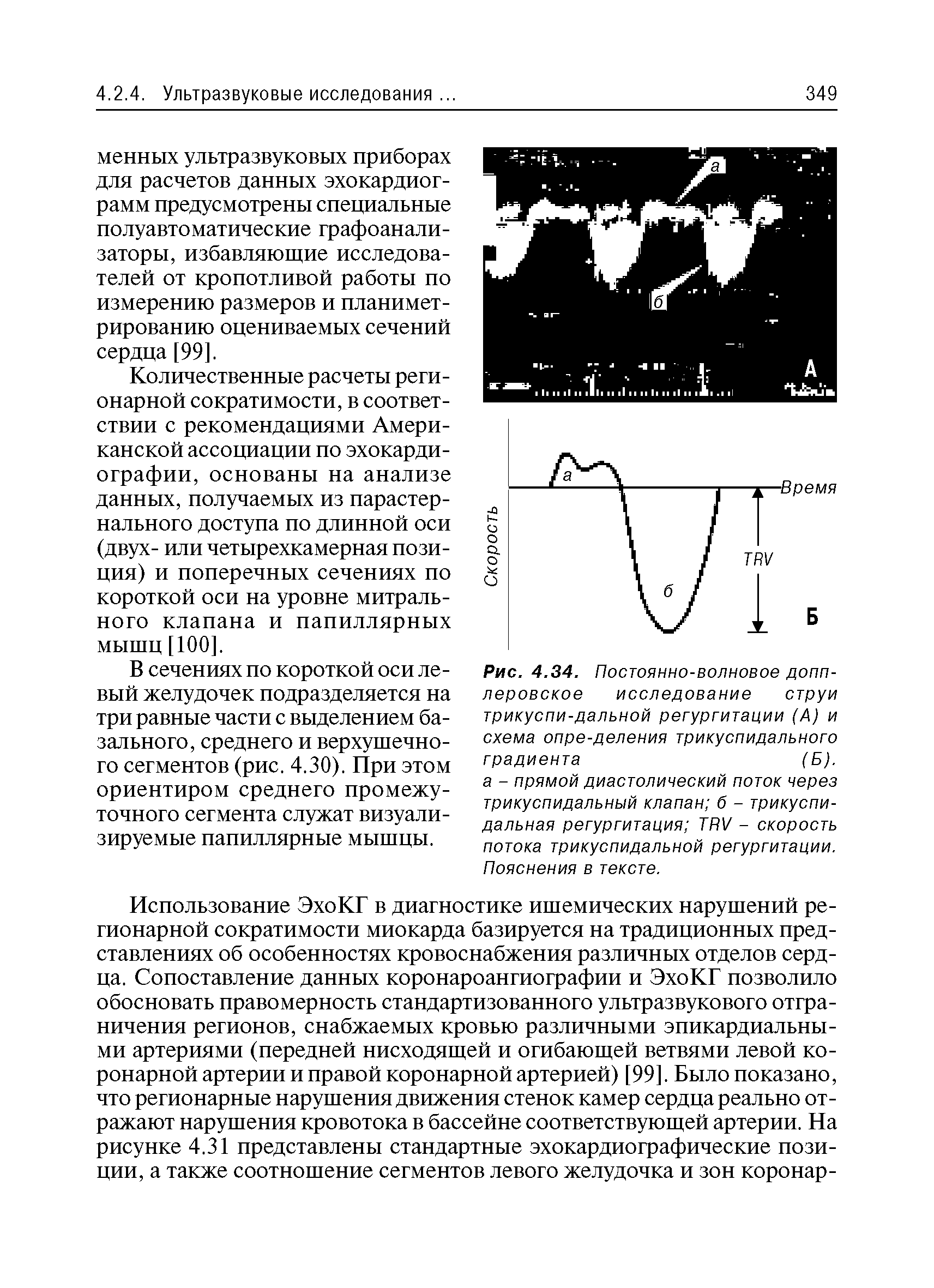 Рис. 4.34. Постоянно-волновое допплеровское исследование струи трикуспи-дальной регургитации (А) и схема опре-деления трикуспидального градиента (Б),...