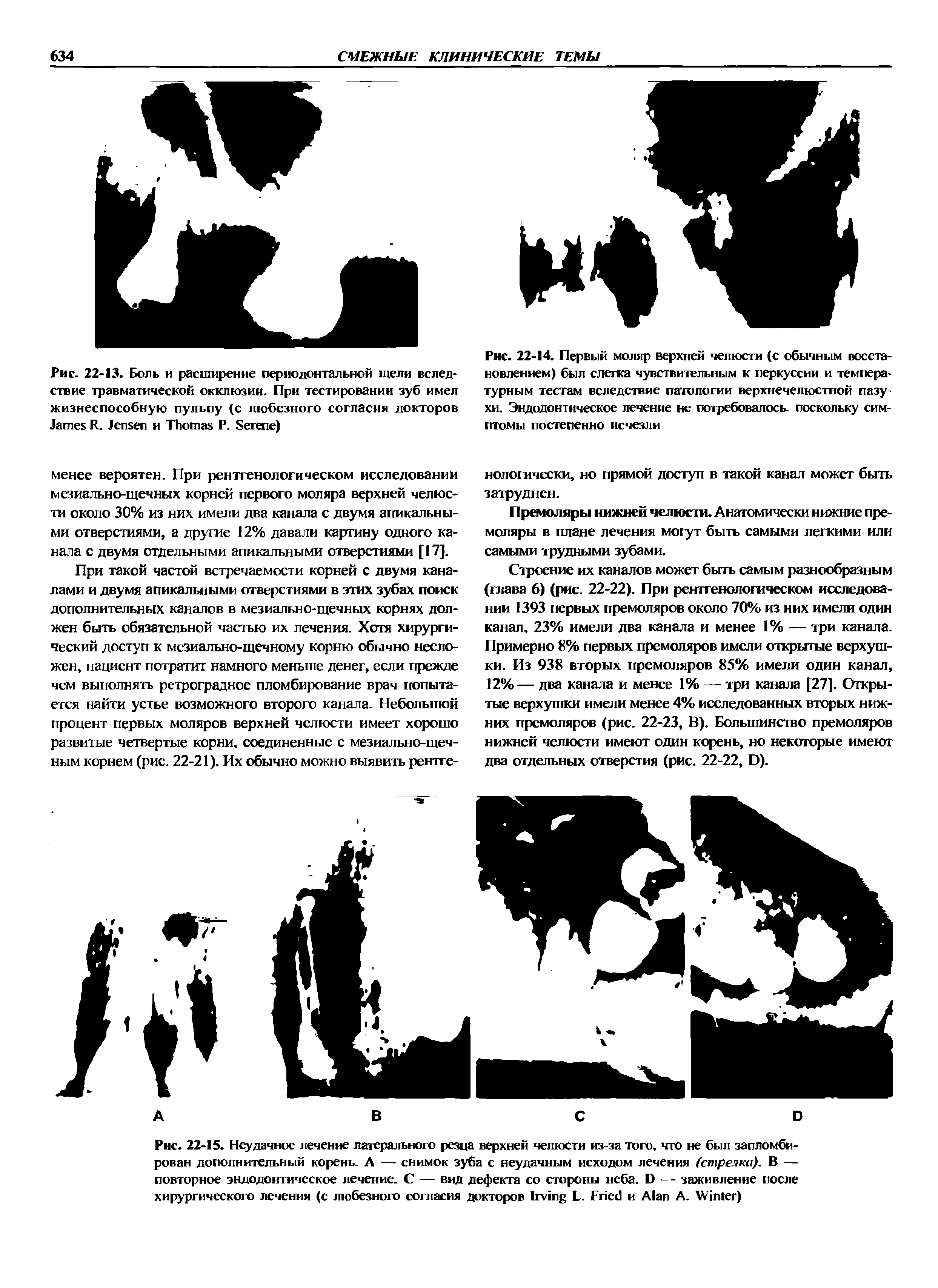 Рис. 22-14. Первый моляр верхней челюсти (с обычным восстановлением) был слегка чувствительным к перкуссии и температурным тестам вследствие патологии верхнечелюстной пазухи. Эндодонтическое лечение не потребовалось, поскольку симптомы постепенно исчезли...