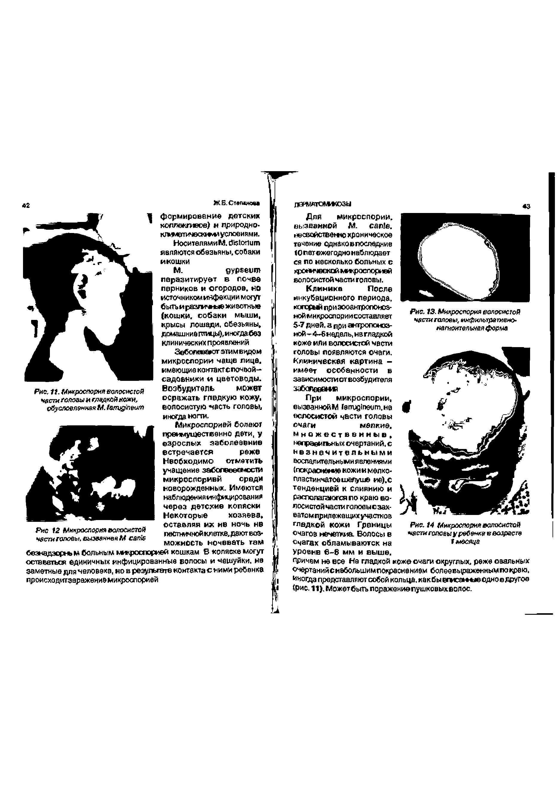 Рис. 11. Микроспория ВОЛОСИСТОЙ части головы и сладкой кожи, обусловленная М. тмпфпеот...