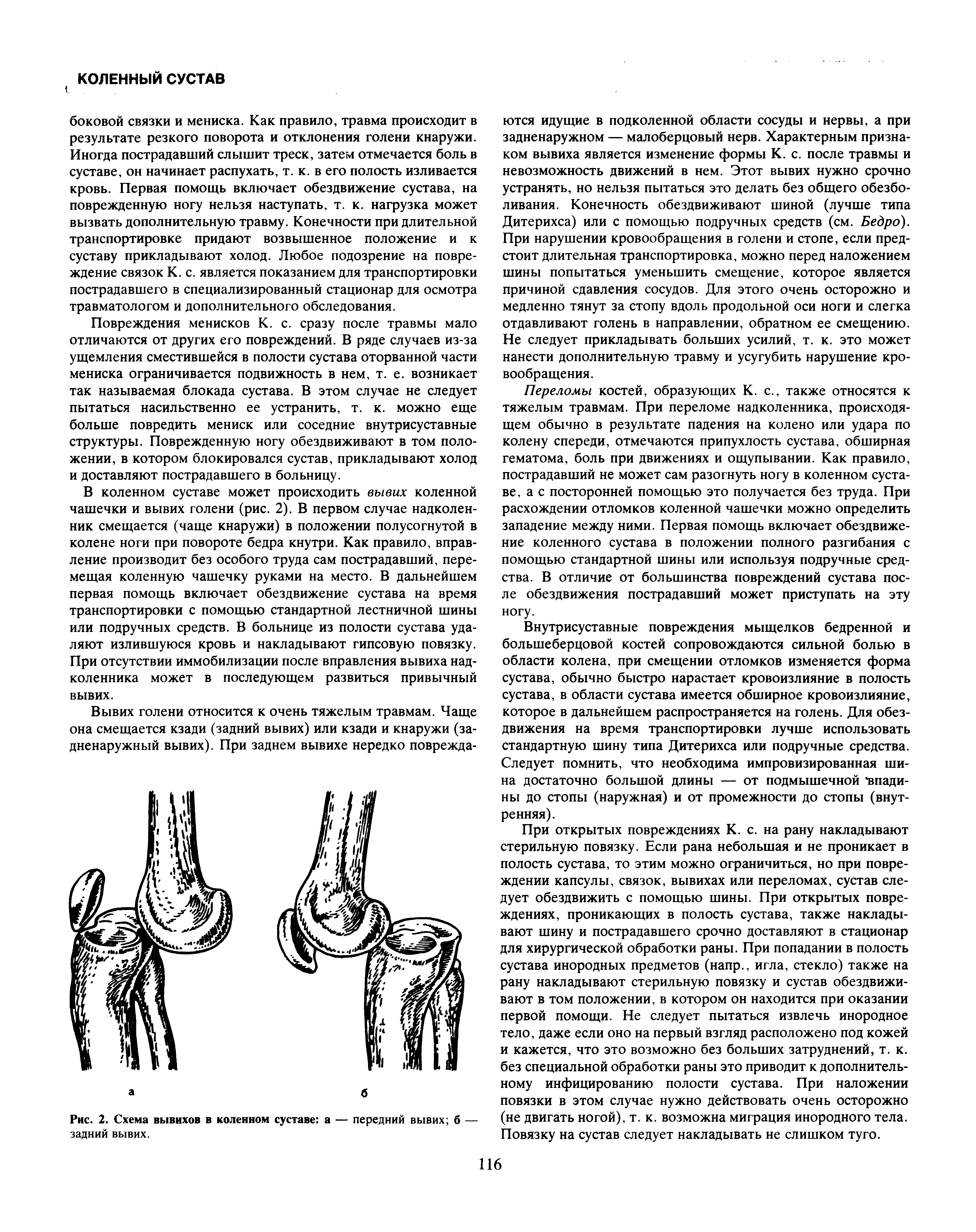 Рис. 2. Схема вывихов в коленном суставе а — передний вывих б — задний вывих.