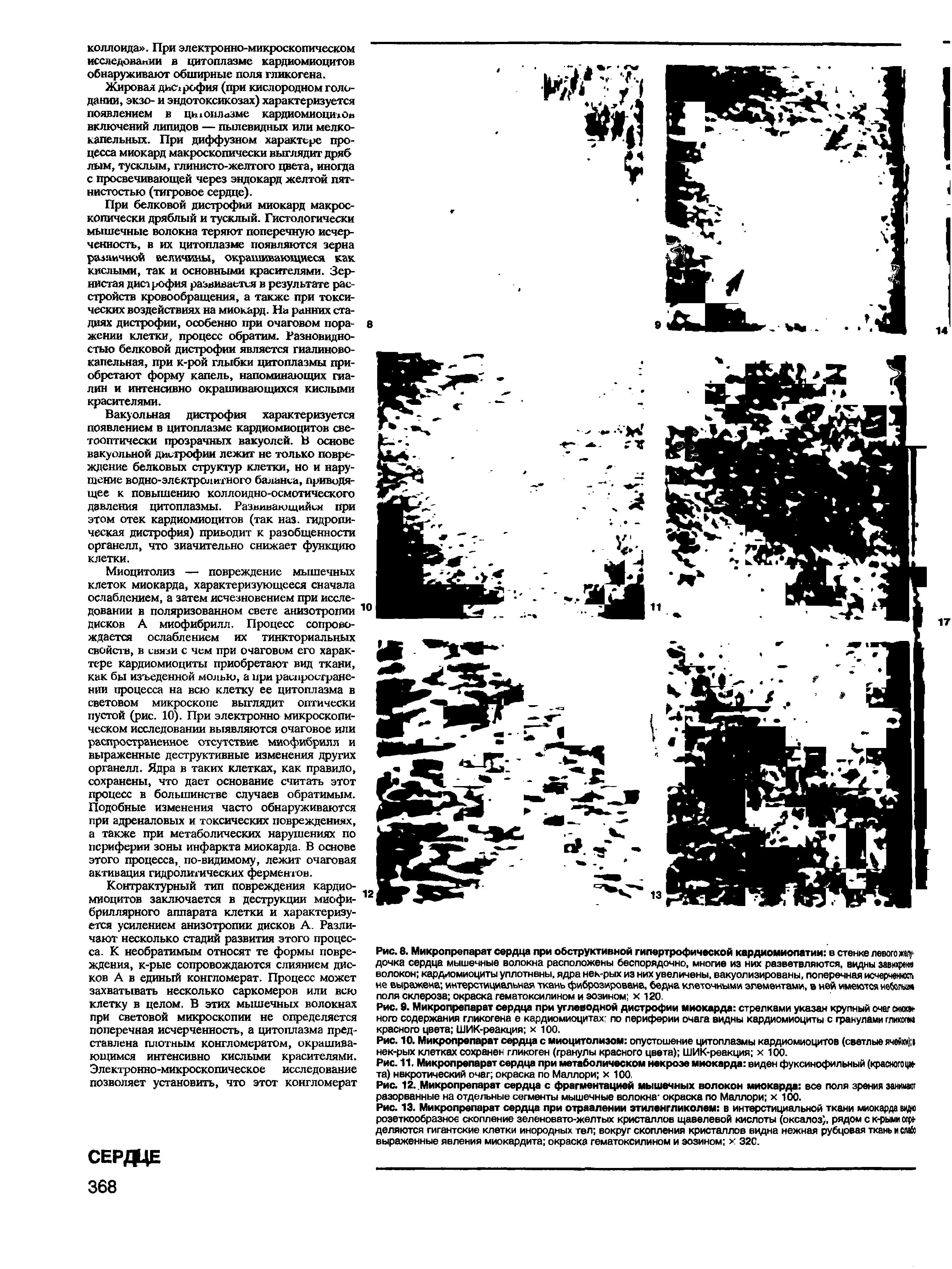 Рис. 12.,Микропрепарат сердца с фрагментацией мышечных волокон миокарда все поля зрения заиимит разорванные на отдельные сегменты мышечные волокна окраска по Маллори х 100.