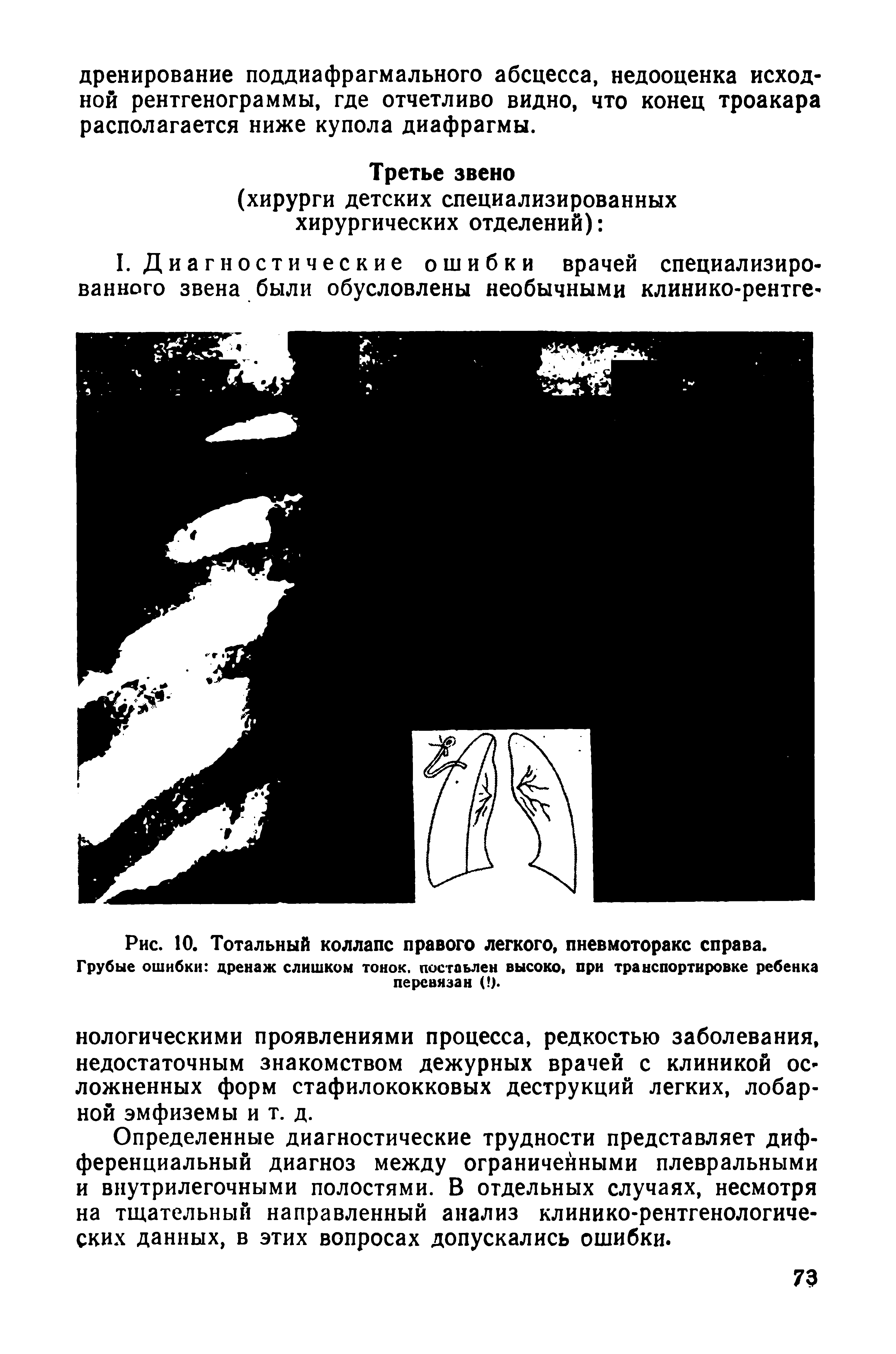 Рис. 10. Тотальный коллапс правого легкого, пневмоторакс справа.