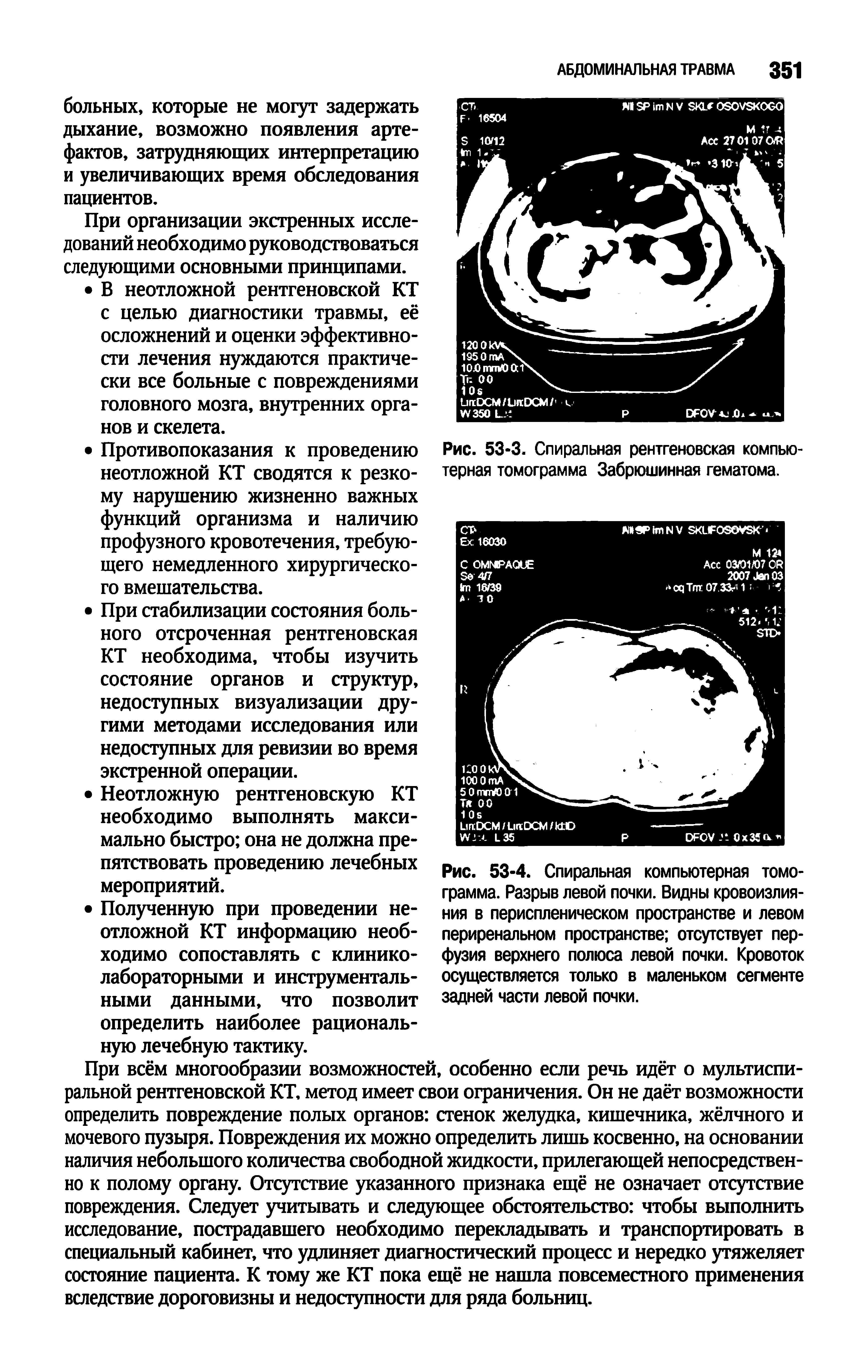 Рис. 53-4. Спиральная компьютерная томограмма. Разрыв левой почки. Видны кровоизлияния в периспленическом пространстве и левом периренальном пространстве отсутствует перфузия верхнего полюса левой почки. Кровоток осуществляется только в маленьком сегменте задней части левой почки.