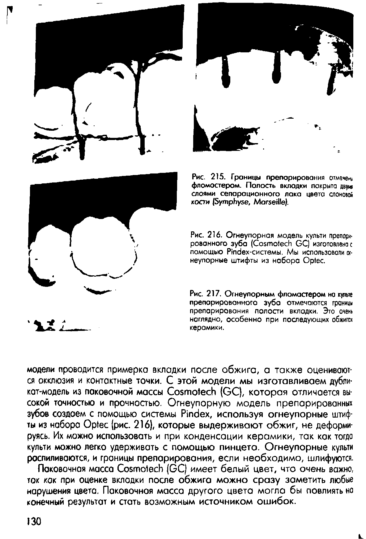 Рис. 215. Границы препарирования отмечен фломостером. Полость вкладки покрыта двумя слоями сепарационного лака цвета слоновой кости (S , M ).