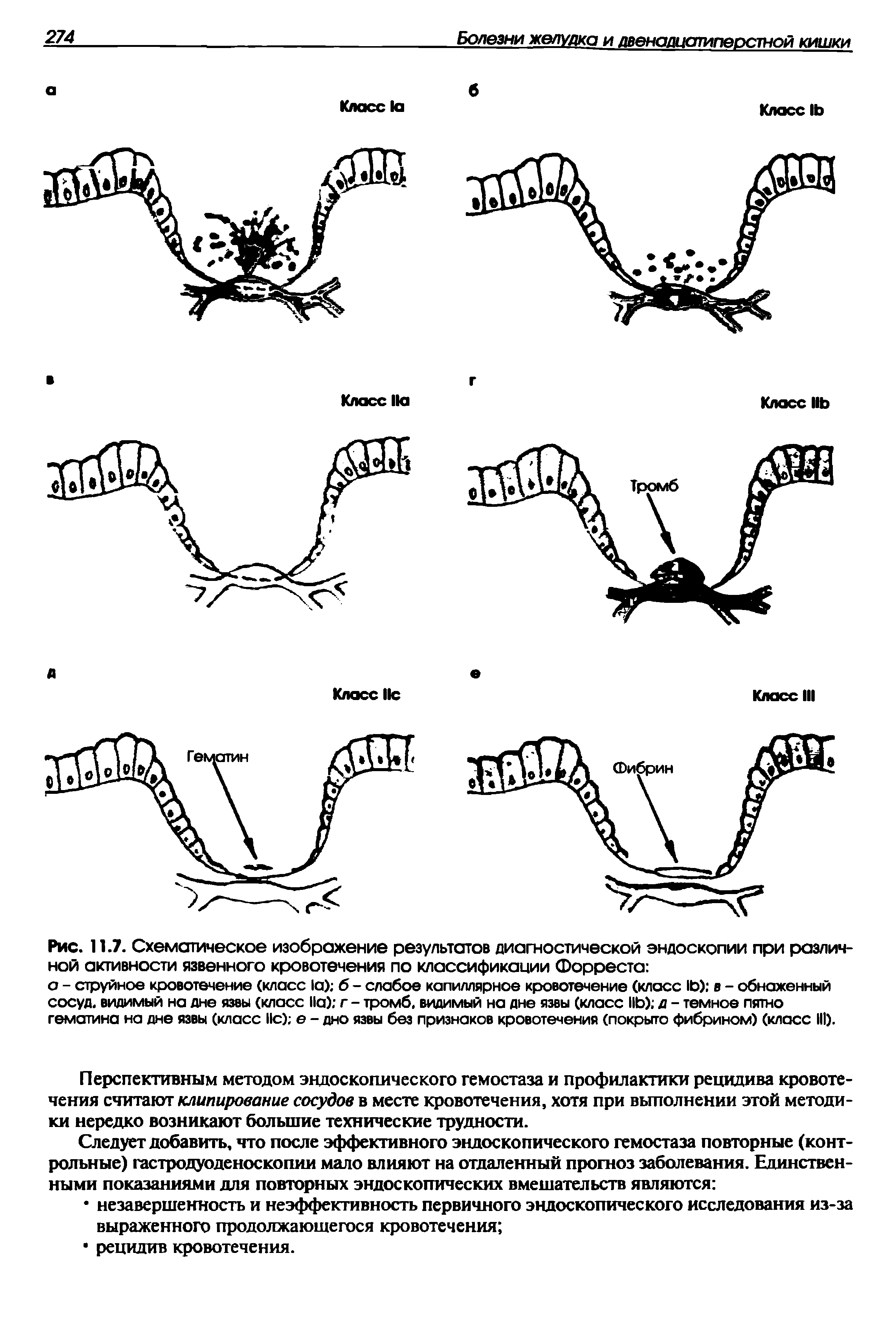 Рис. 11.7. Схематическое изображение результатов диагностической эндоскопии при различной активности язвенного кровотечения по классификации Форреста ...