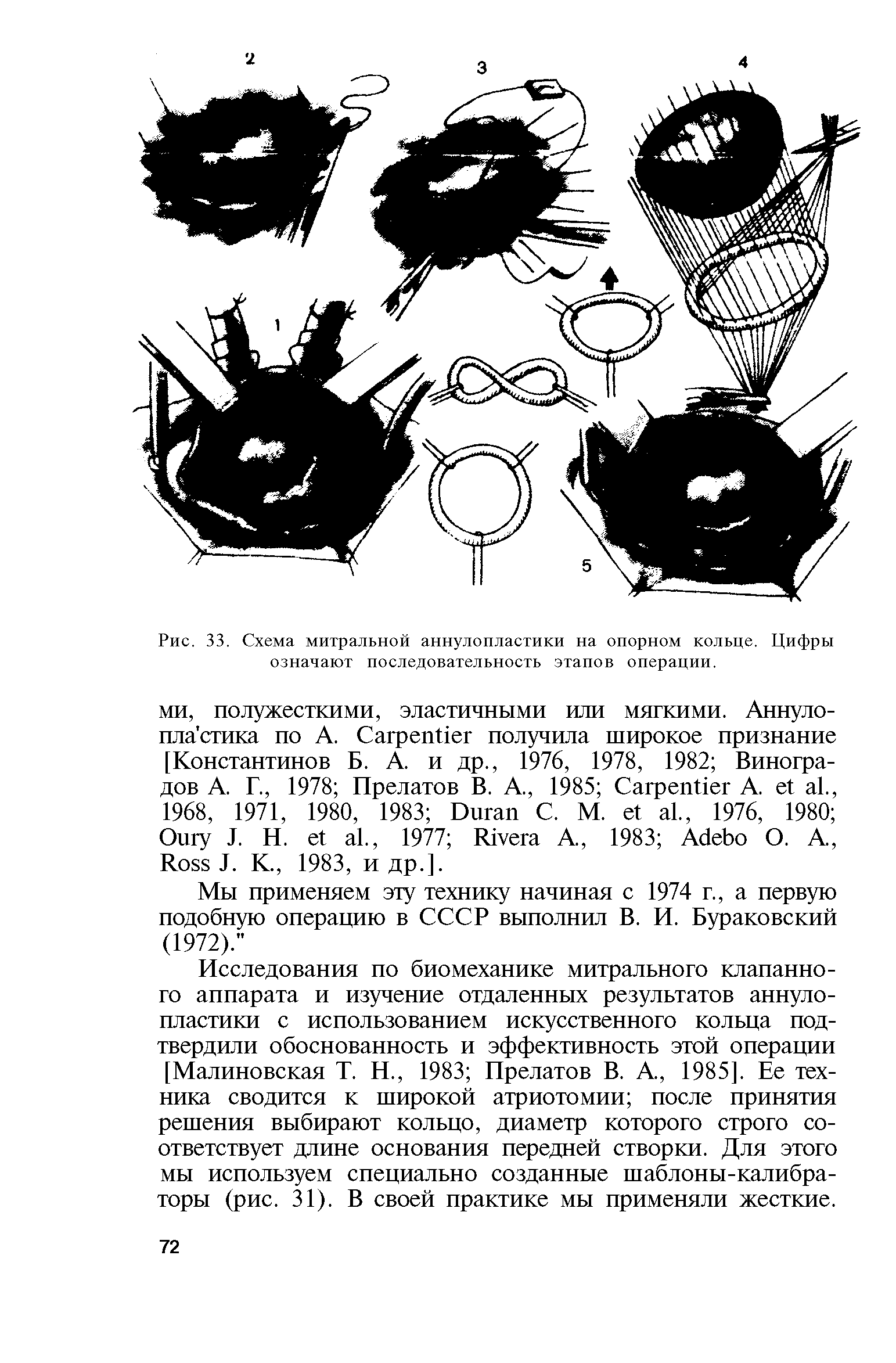 Рис. 33. Схема митральной аннулопластики на опорном кольце. Цифры означают последовательность этапов операции.