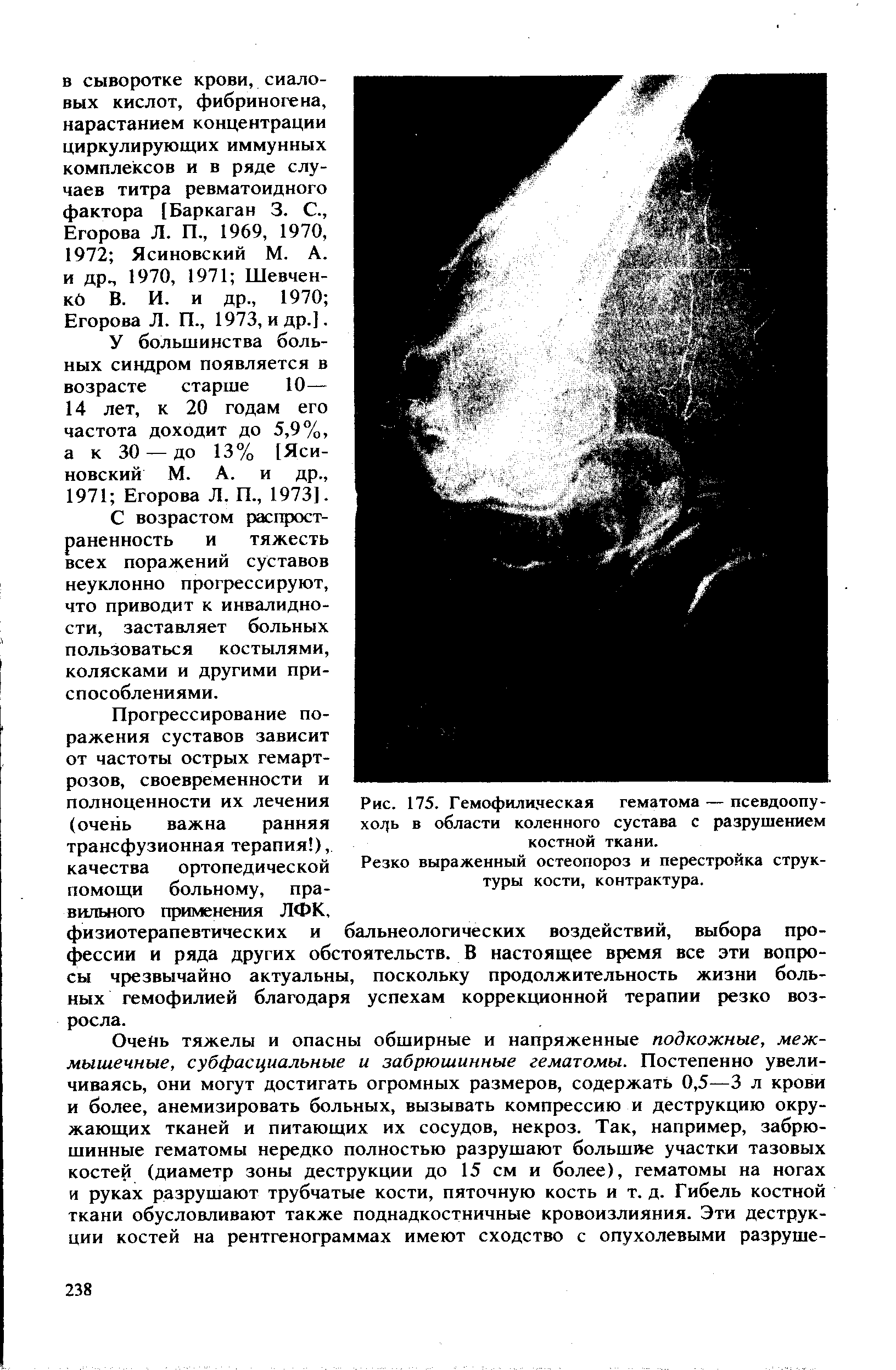 Рис. 175. Гемофилическая гематома — псевдоопу-ходь в области коленного сустава с разрушением костной ткани.