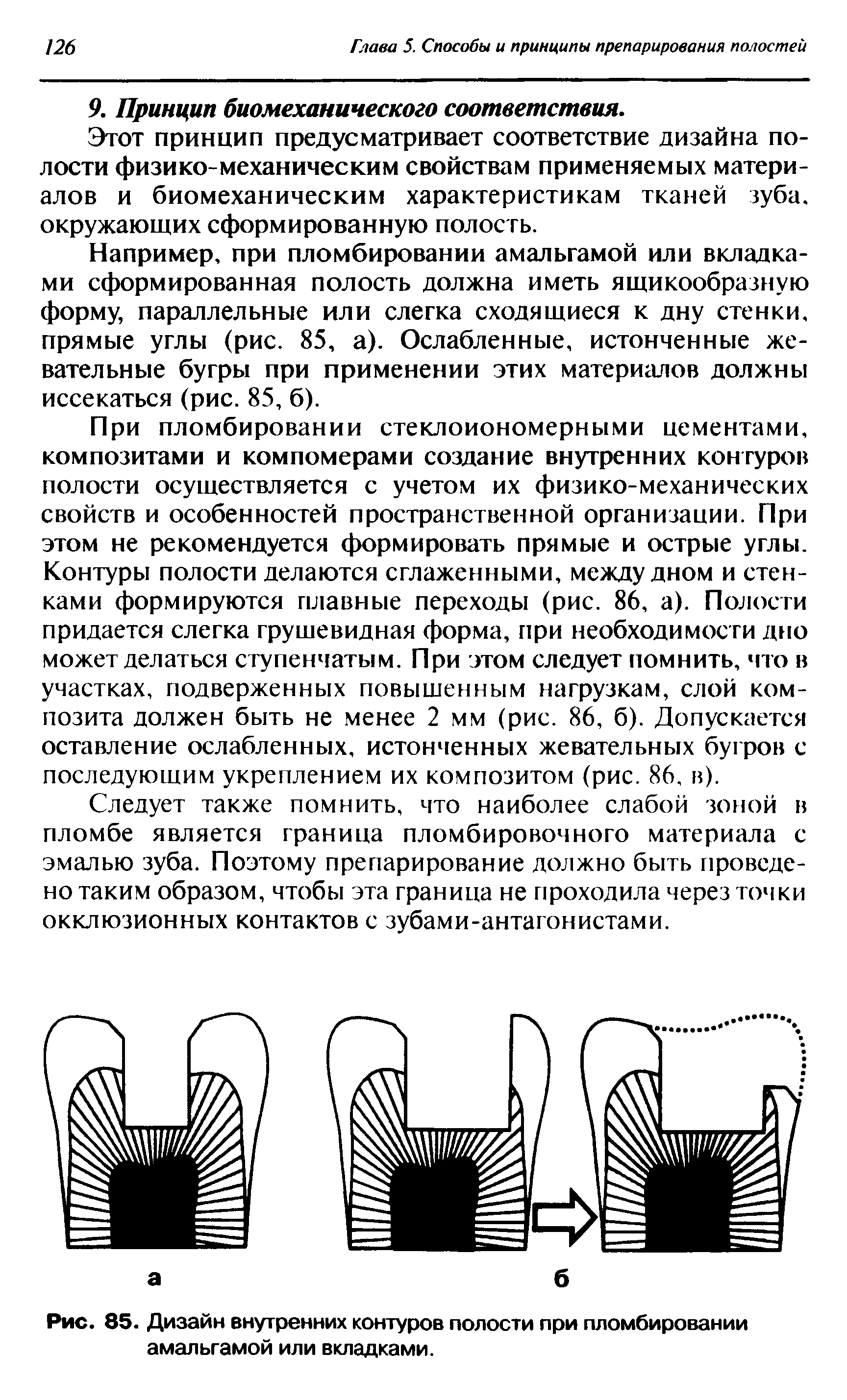 Рис. 85. Дизайн внутренних контуров полости при пломбировании амальгамой или вкладками.