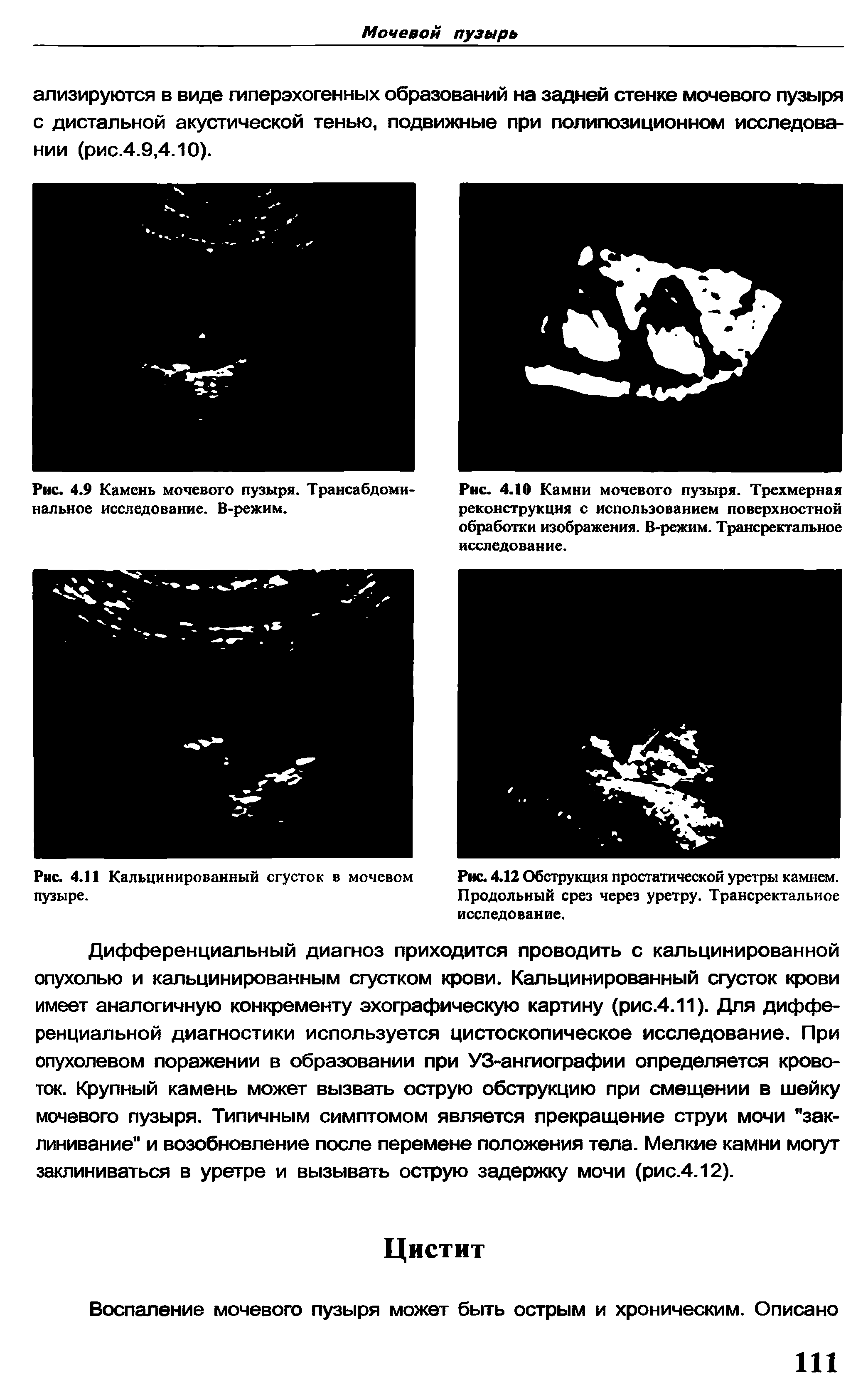 Рис. 4.9 Камень мочевого пузыря. Трансабдоминальное исследование. В-режим.