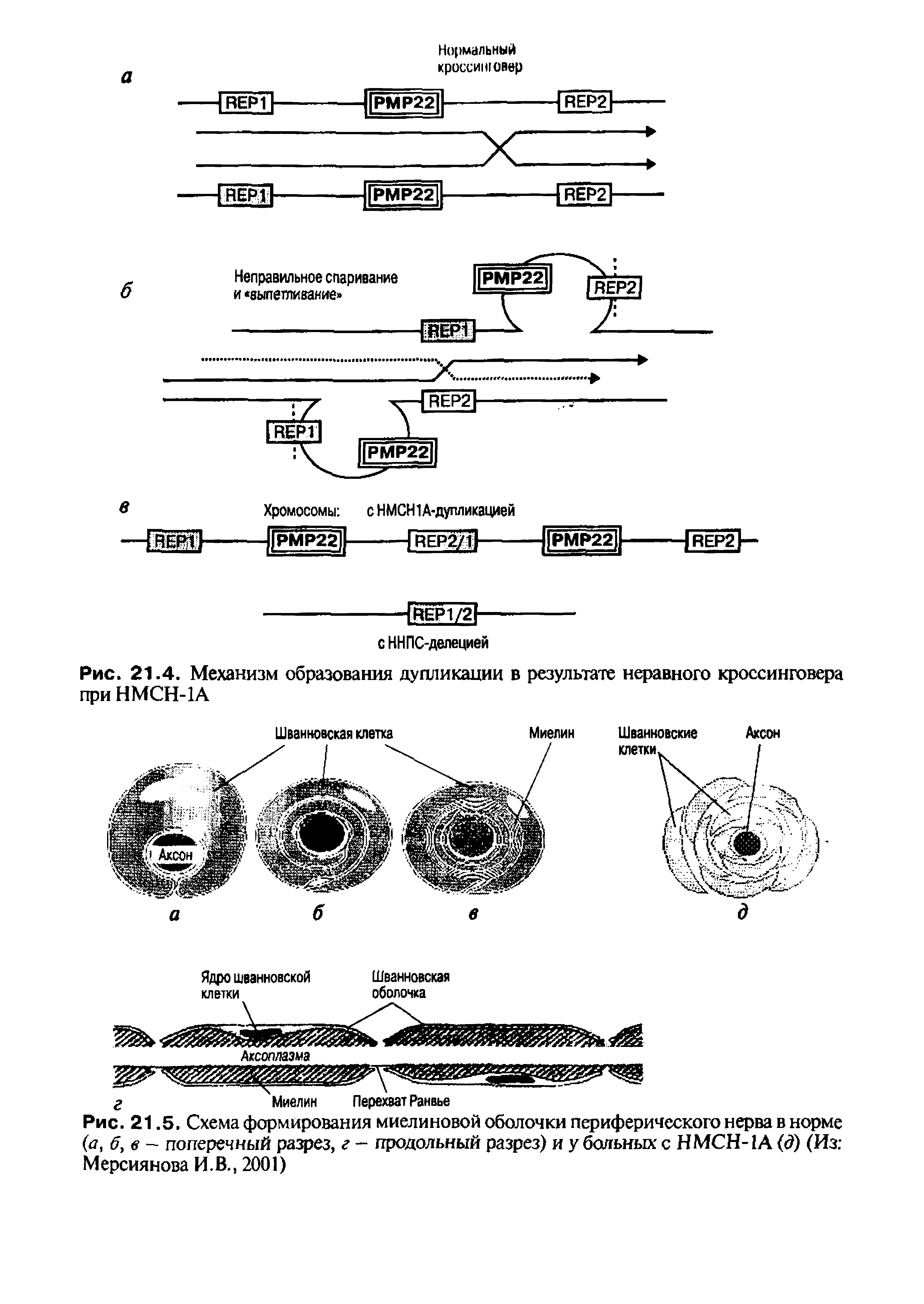 Рис. 21.5, Схема формирования миелиновой оболочки периферического нерва в норме (а, б, в - поперечный разрез, г - продольный разрез) и у больных с НМСН-1А (д) (Из Мерсиянова И.В., 2001)...