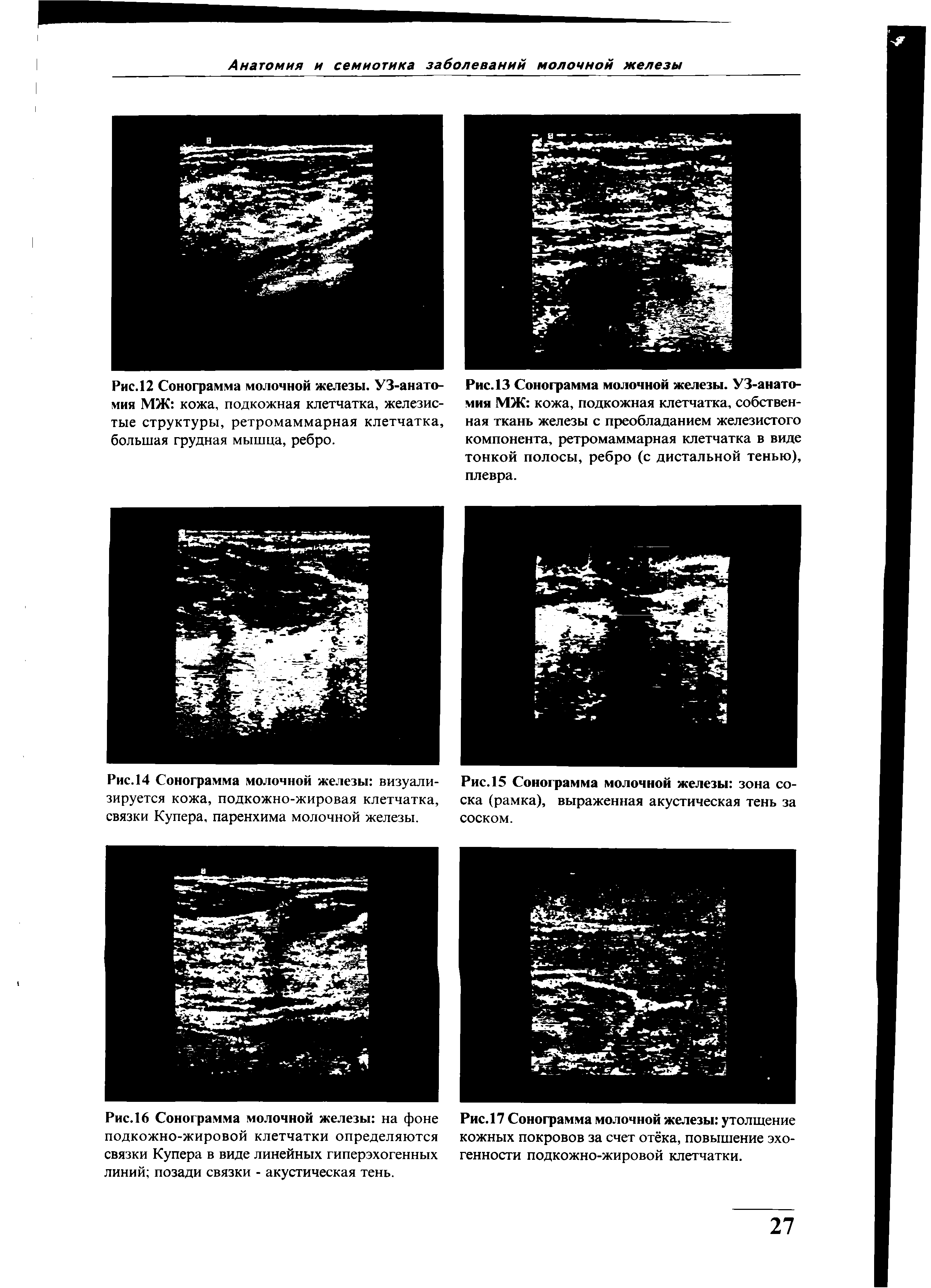 Рис. 14 Сонограмма молочной железы визуализируется кожа, подкожно-жировая клетчатка, связки Купера, паренхима молочной железы.