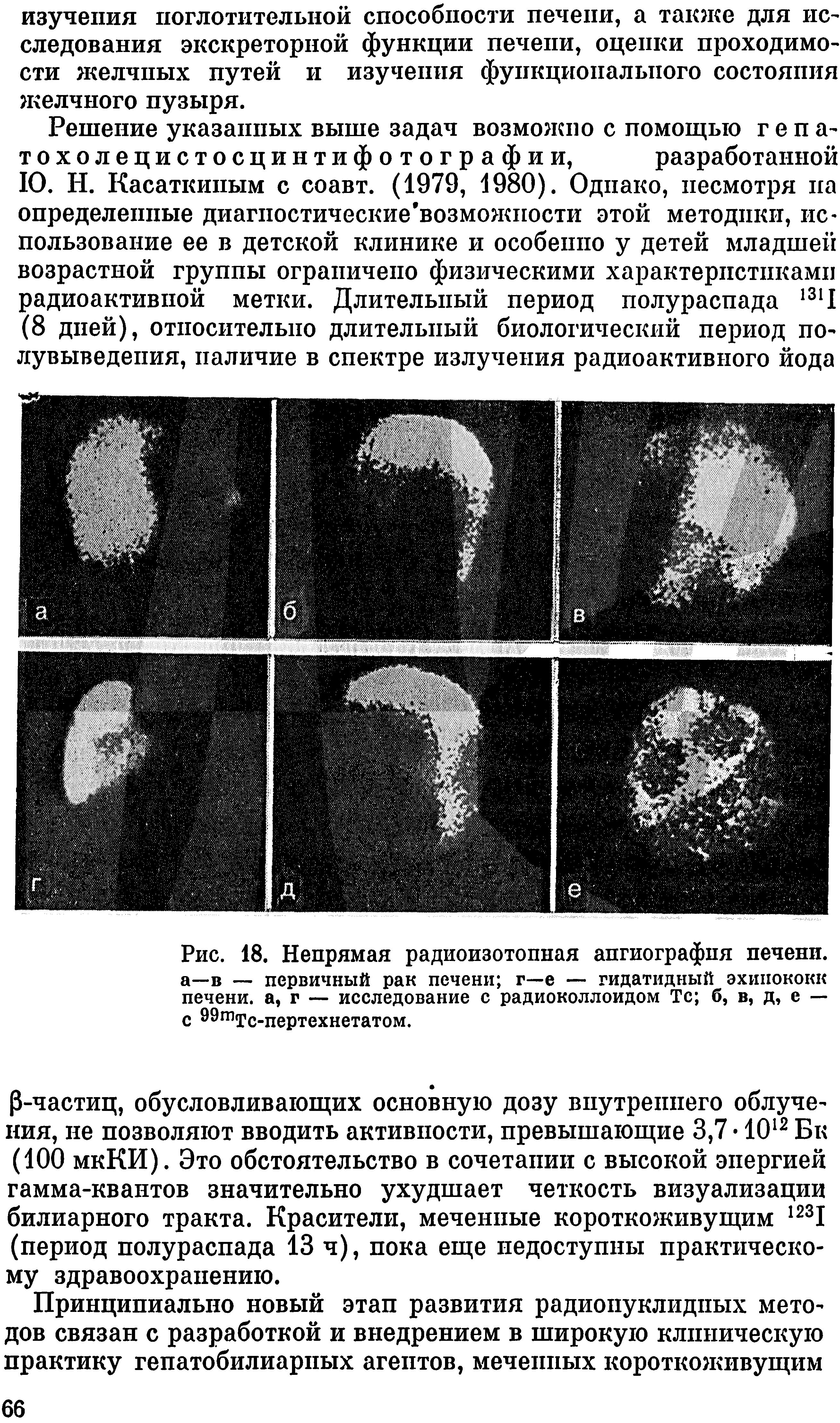 Рис. 18. Непрямая радиоизотопная ангиография печени, а—в — первичный рак печени г—е — гидатидный эхинококк печени, а, г — исследование с радиоколлоидом Тс б, в, д, е — с 99тТс-пертехнетатом.