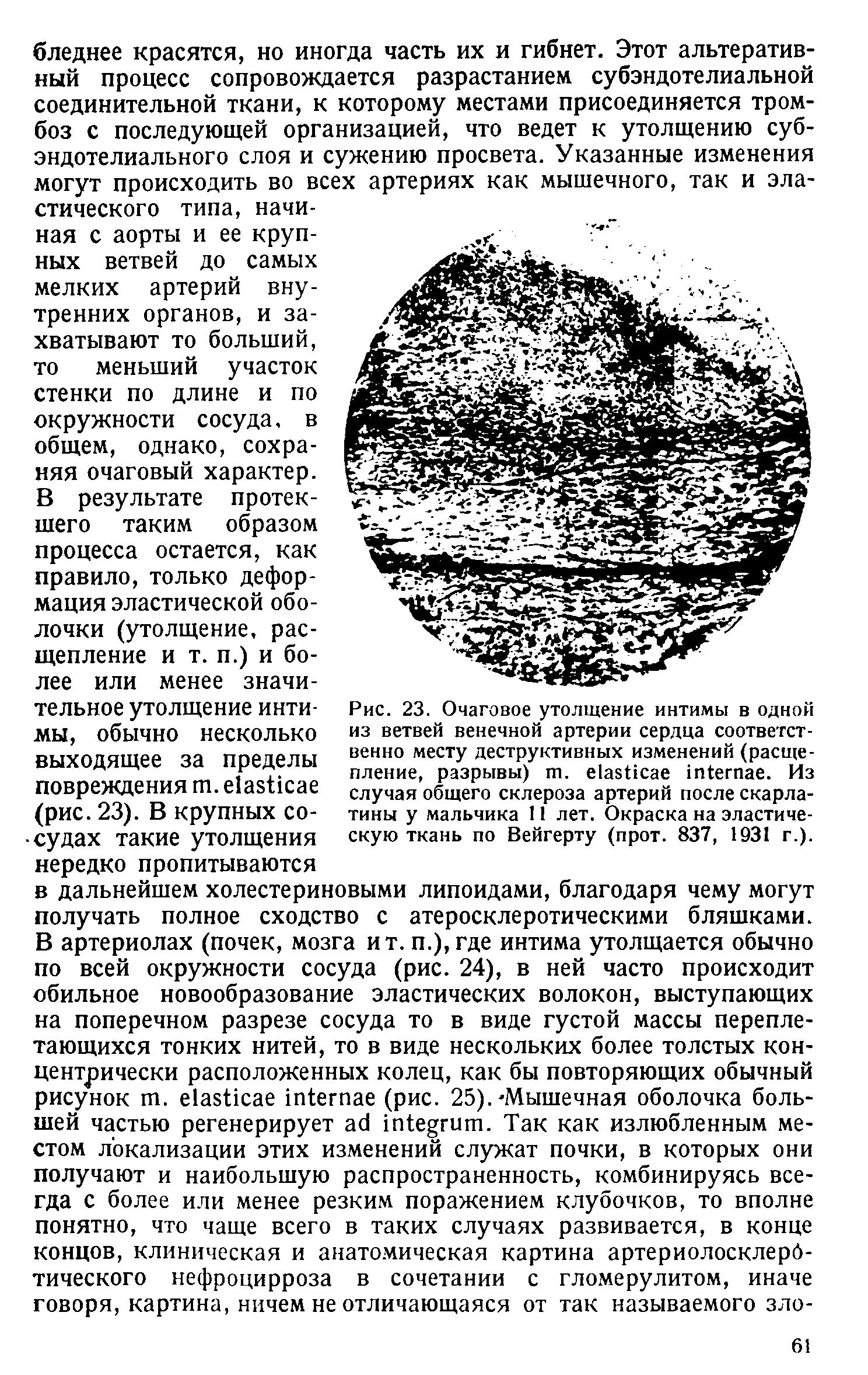 Рис. 23. Очаговое утолщение интимы в одной из ветвей венечной артерии сердца соответственно месту деструктивных изменений (расщепление, разрывы) т. е1азНсае гИегпае. Из случая общего склероза артерий после скарлатины у мальчика 11 лет. Окраска на эластическую ткань по Вейгерту (прот. 837, 1931 г.).