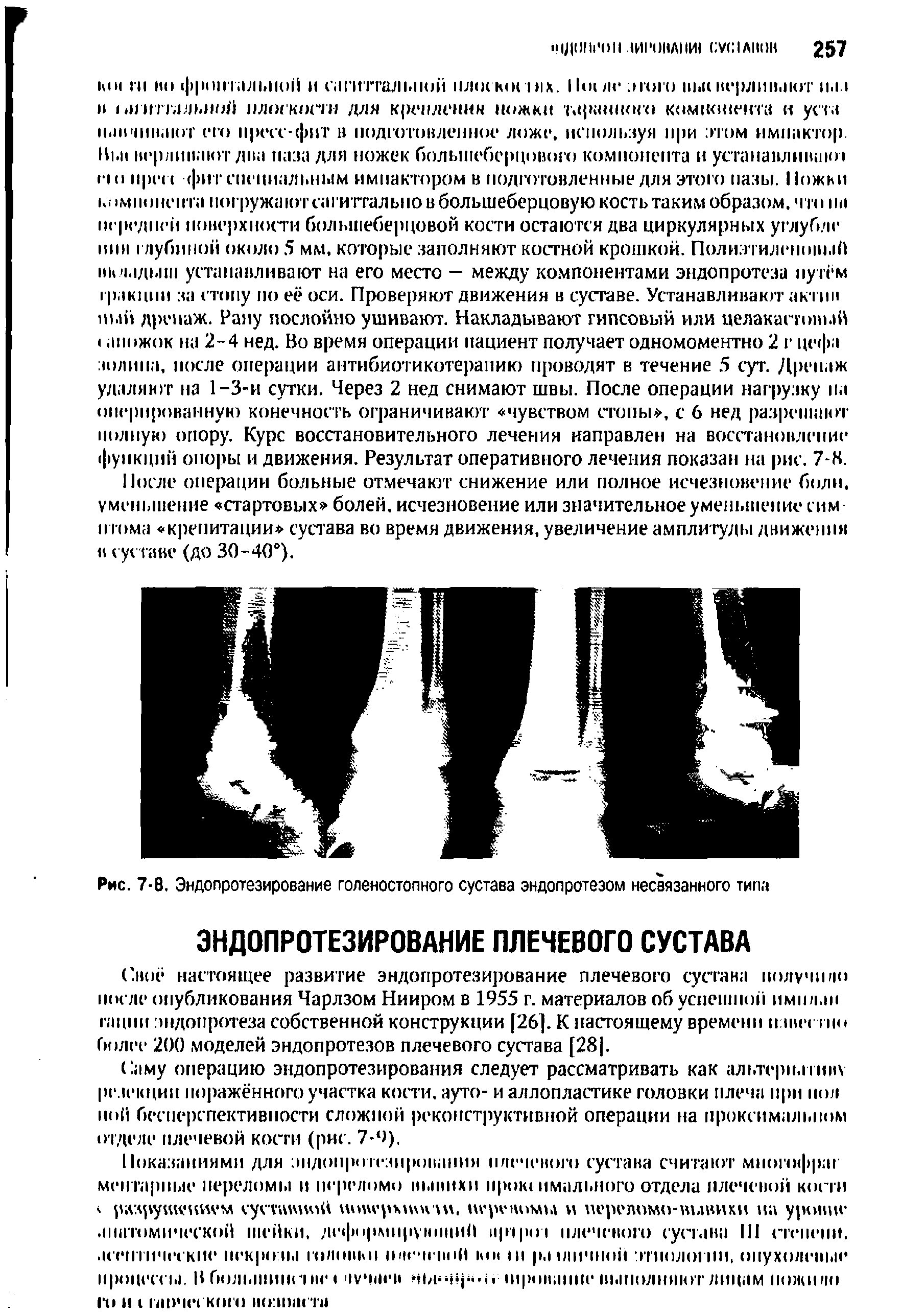 Рис. 7-8. Эндопротезирование голеностопного сустава эндопротезом несвязанного типа...