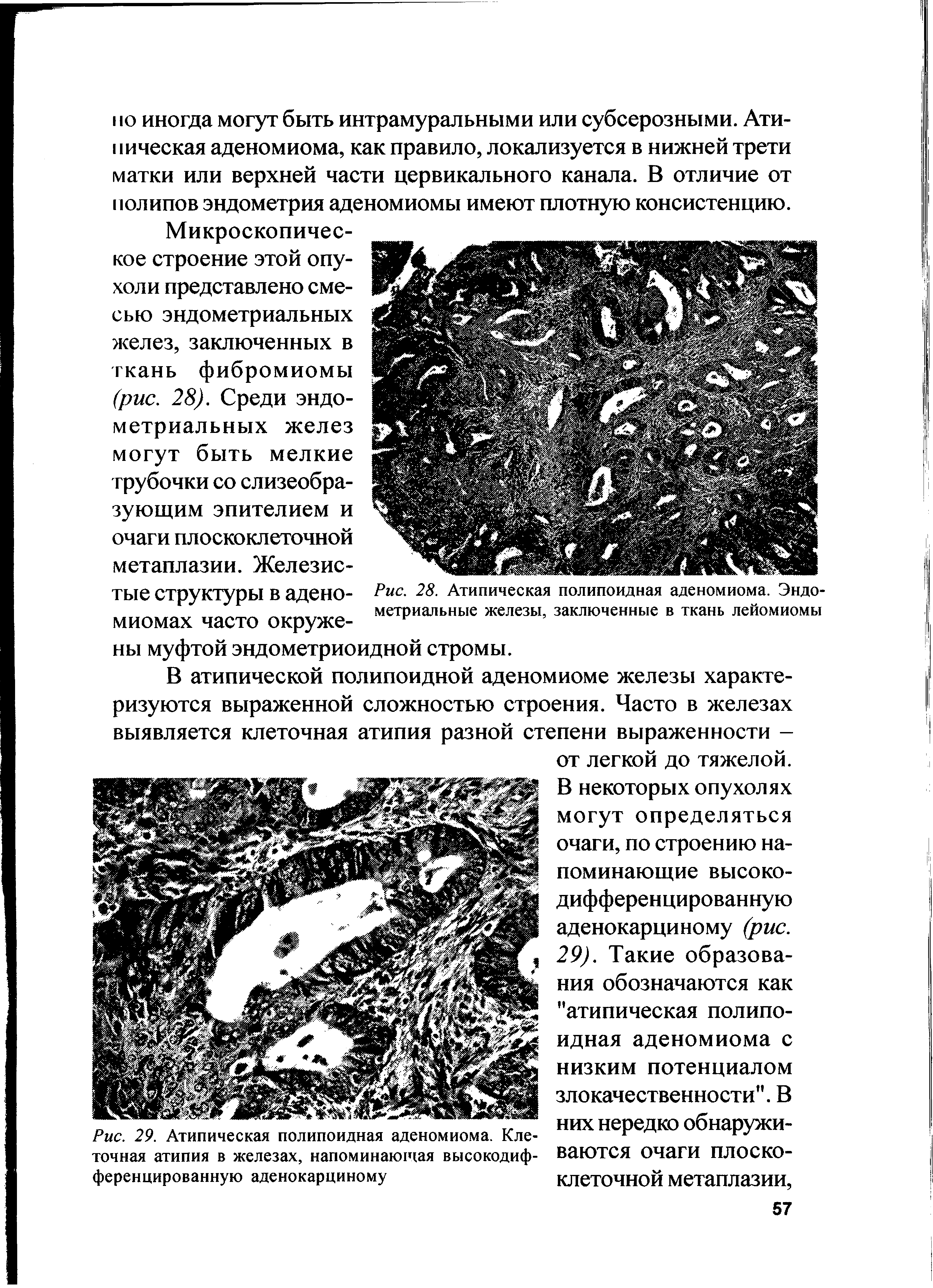 Рис. 29. Атипическая полипоидная аденомиома. Клеточная атипия в железах, напоминающая высокодифференцированную аденокарциному...