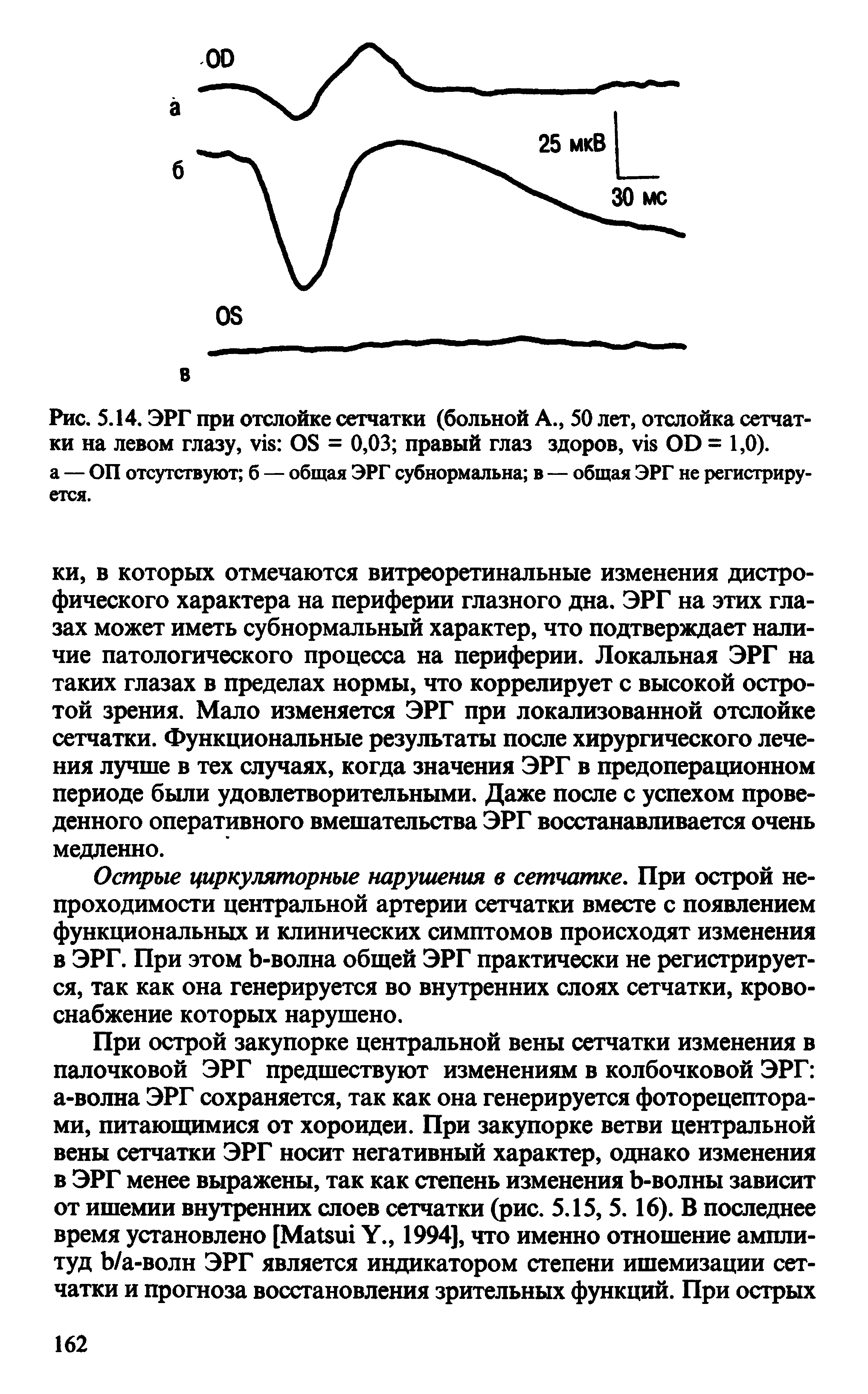 Рис. 5.14. ЭРГ при отслойке сетчатки (больной А., 50 лет, отслойка сетчатки на левом глазу, OS = 0,03 правый глаз здоров, OD = 1,0).