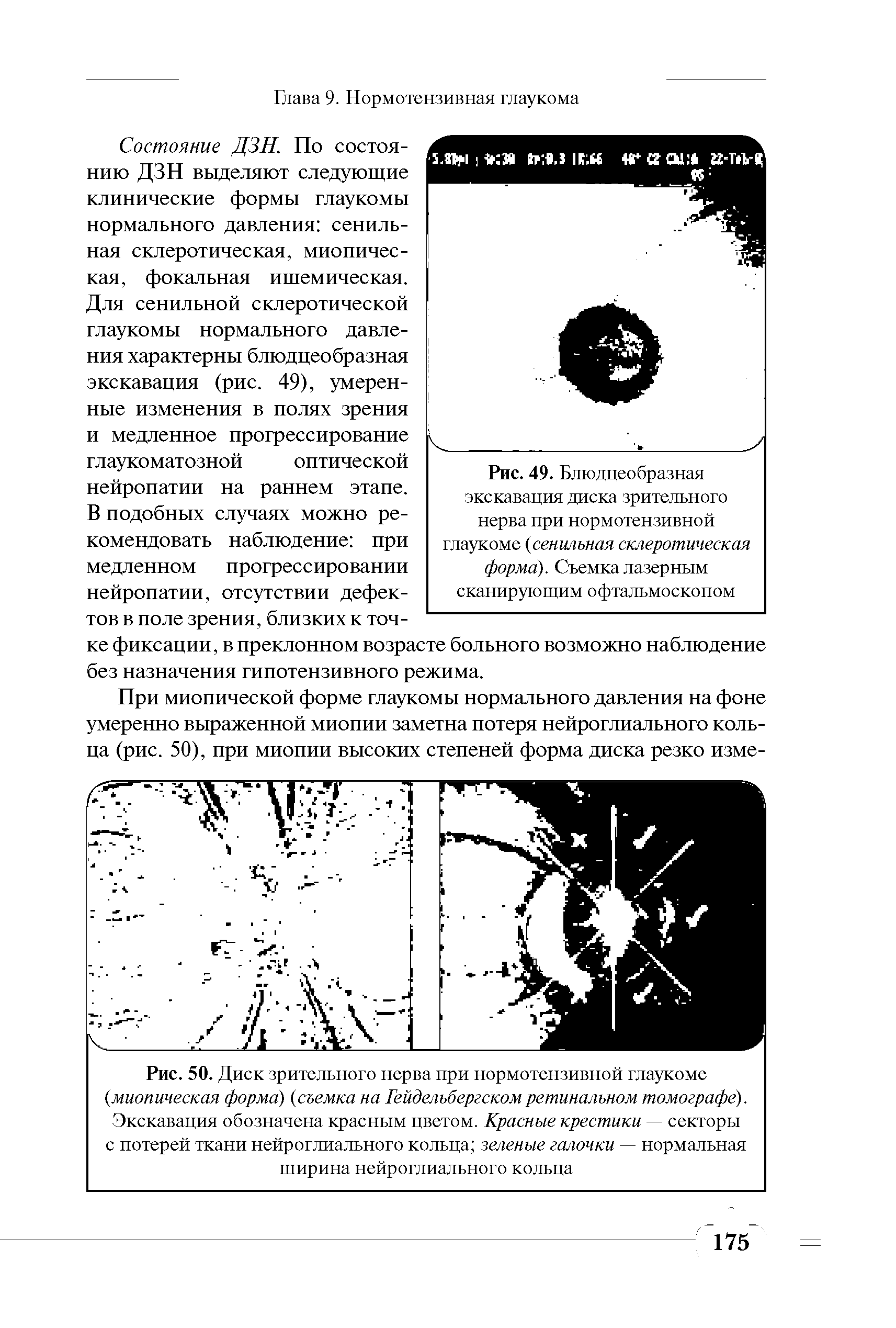 Рис. 49. Блюдцеобразная экскавация диска зрительного нерва при нормотензивной глаукоме (сенильная склеротическая форма). Съемка лазерным сканирующим офтальмоскопом...