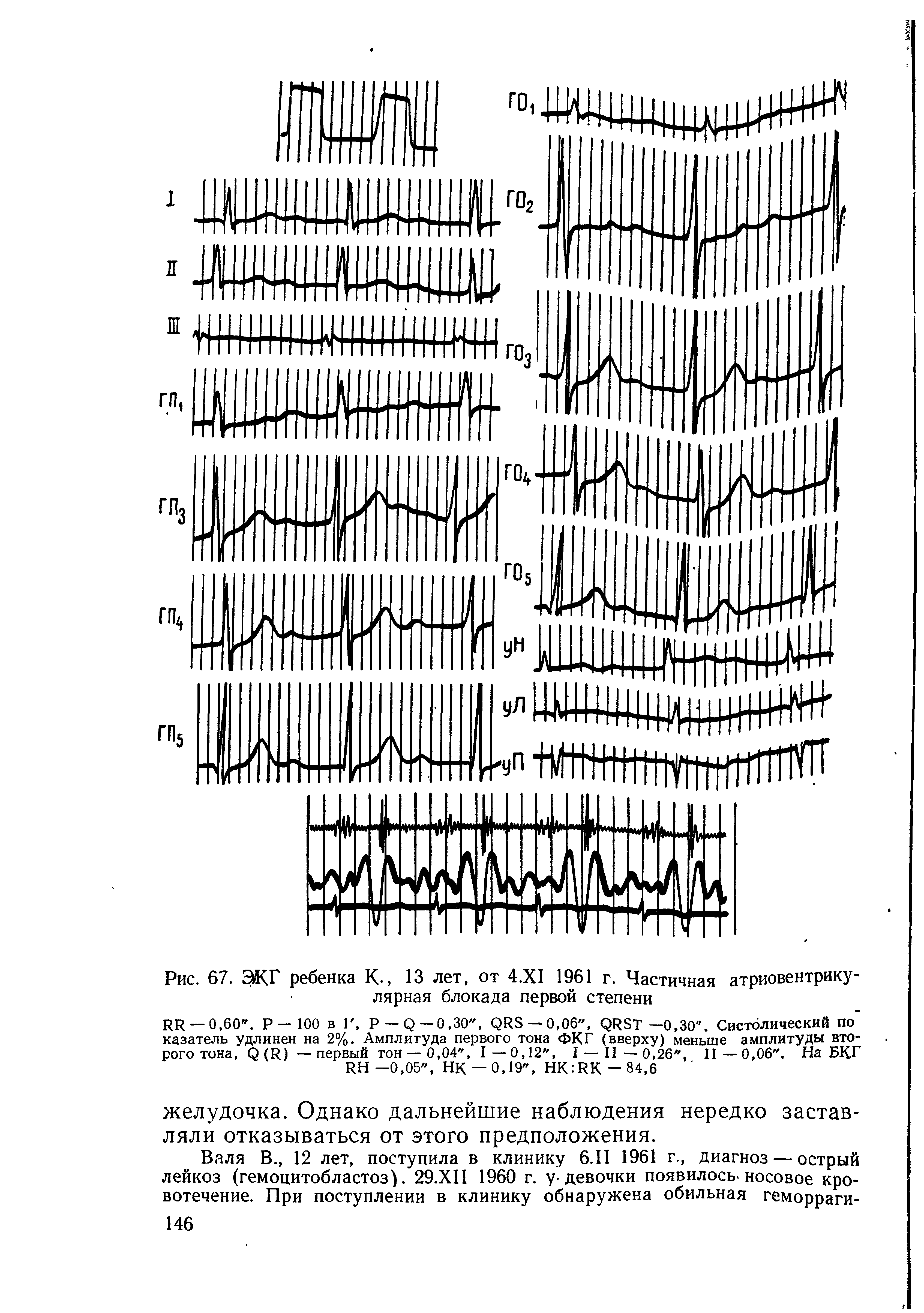 Рис. 67. ЭКГ ребенка К , 13 лет, от 4.Х1 1961 г. Частичная атриовентрикулярная блокада первой степени...