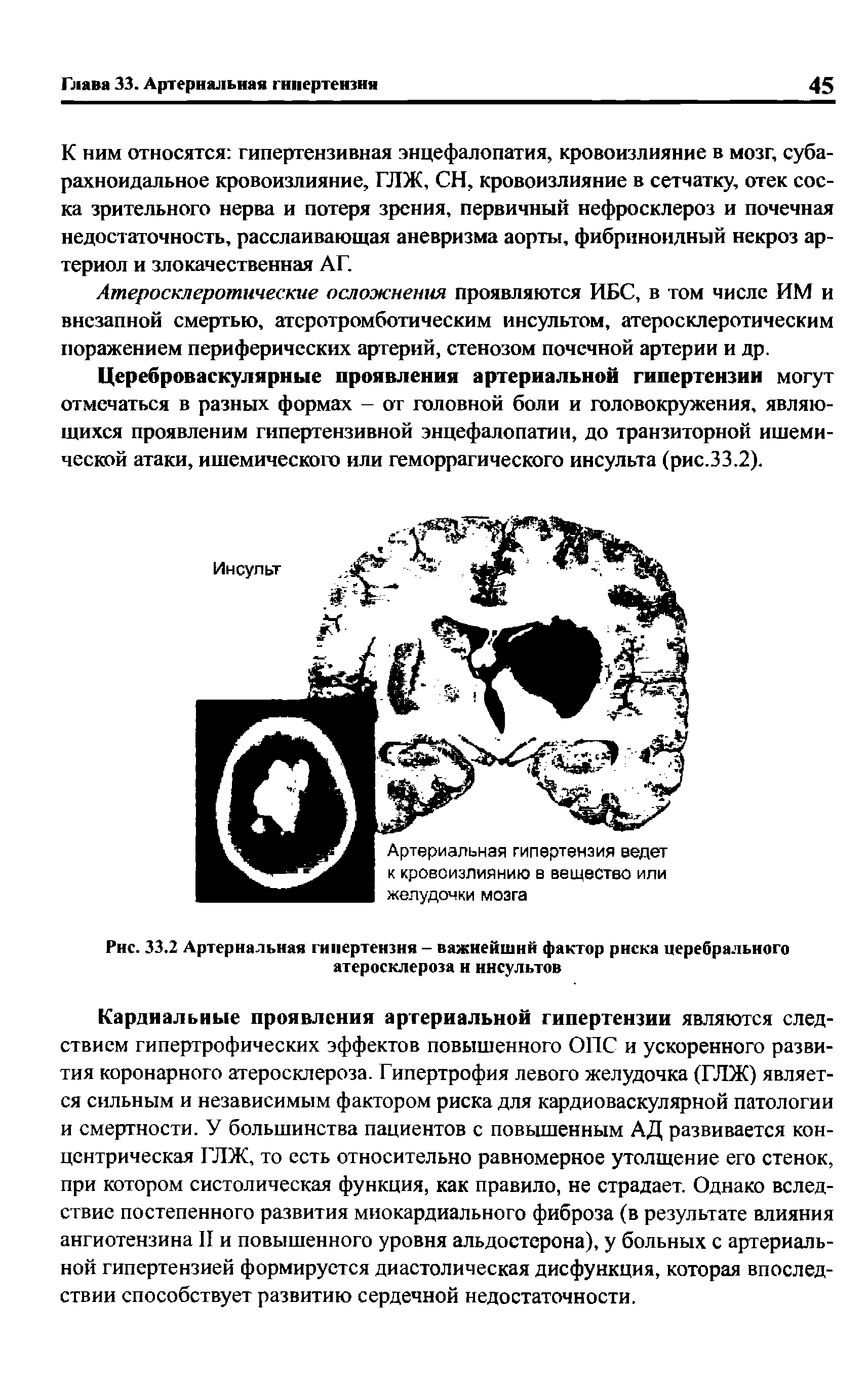 Рис. 33.2 Артериальная гипертензия - важнейший фактор риска церебрального атеросклероза и инсультов...