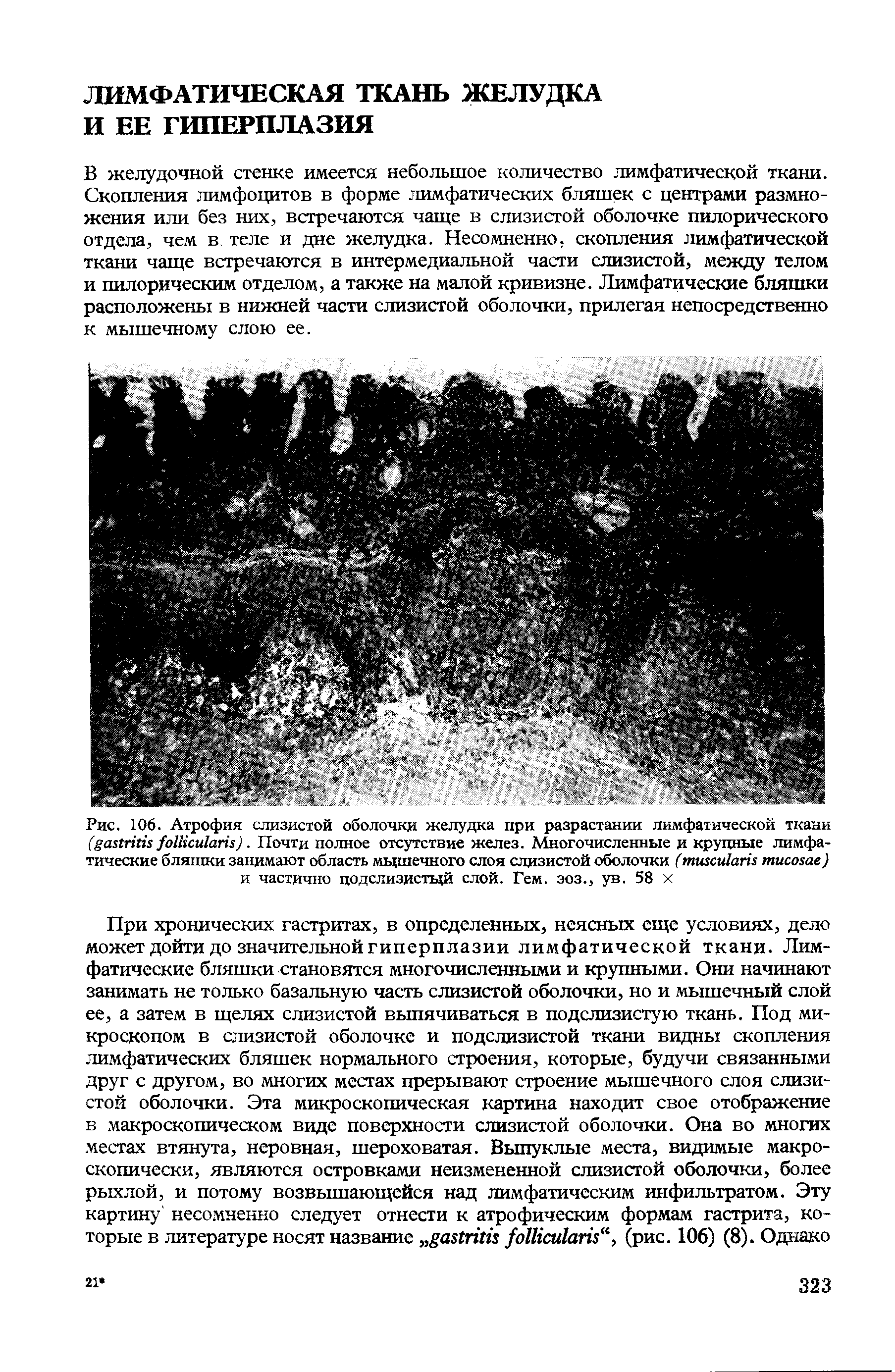 Рис. 106. Атрофия слизистой оболочки желудка при разрастании лимфатической ткани ( ). Почти полное отсутствие желез. Многочисленные и крупные лимфатические бляшки занимают область мышечного слоя слизистой оболочки ( ) и частично подслизистый слой. Гем. эоз., ув. 58 х...