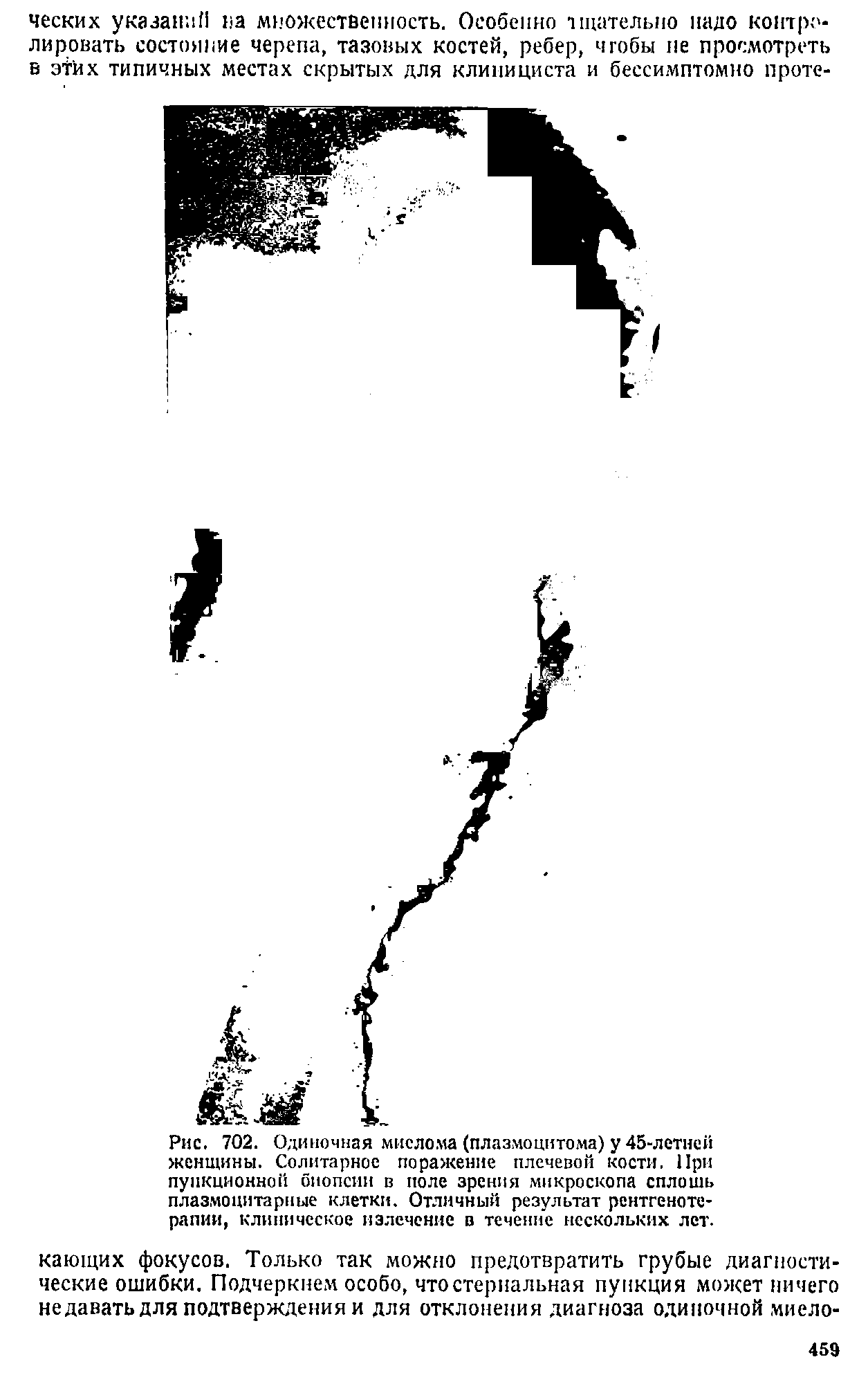 Рис. 702. Одиночная миелома (плазмоцитома) у 45-летней женщины. Солитарное поражение плечевой кости. При пункционной биопсии в поле зрения микроскопа сплошь плазмоцитарные клетки. Отличный результат рентгенотерапии, клиническое излечение в течение нескольких лет.