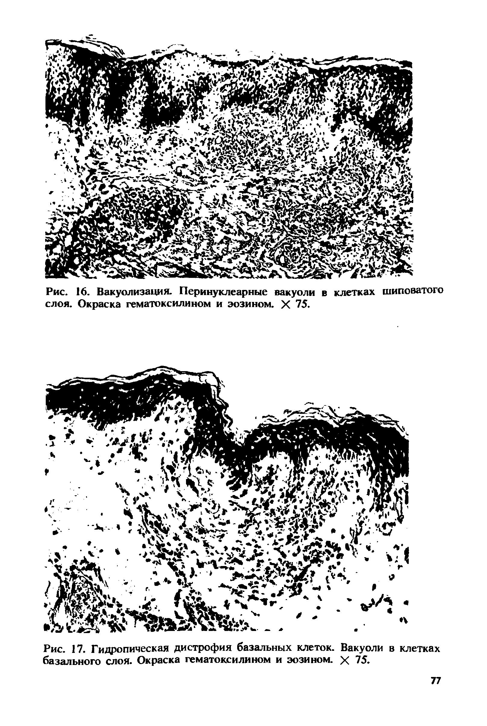 Рис. 17. Гидропическая дистрофия базальных клеток. Вакуоли в клетках базального слоя. Окраска гематоксилином и эозином. X 75.