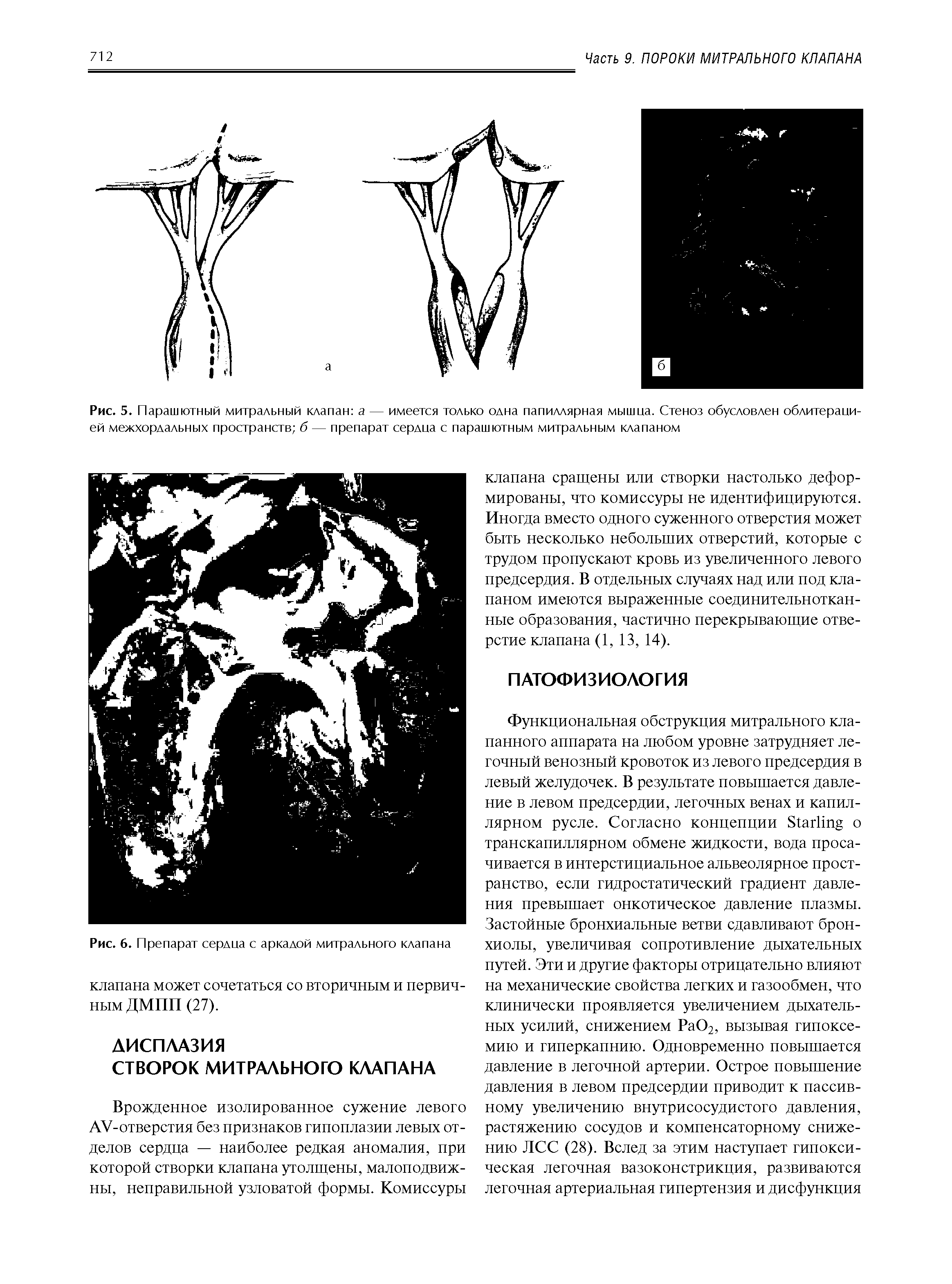 Рис. 5. Парашютный митральный клапан а — имеется только одна папиллярная мышца. Стеноз обусловлен облитерацией межхордальных пространств б— препарат сердца с парашютным митральным клапаном...