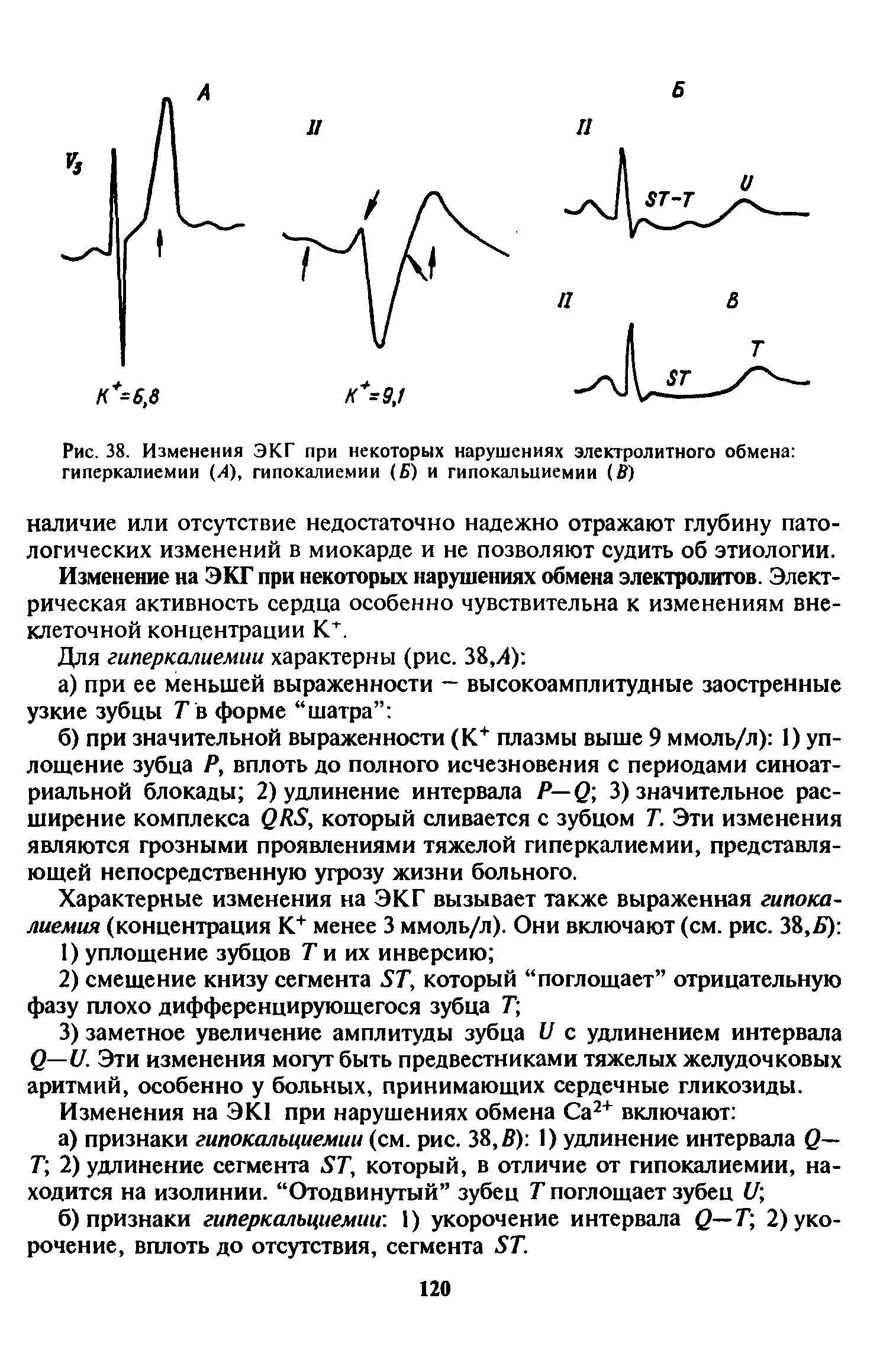 Рис. 38. Изменения ЭКГ при некоторых нарушениях электролитного обмена гиперкалиемии (Л), гипокалиемии ( ) и гипокальциемии (В)...