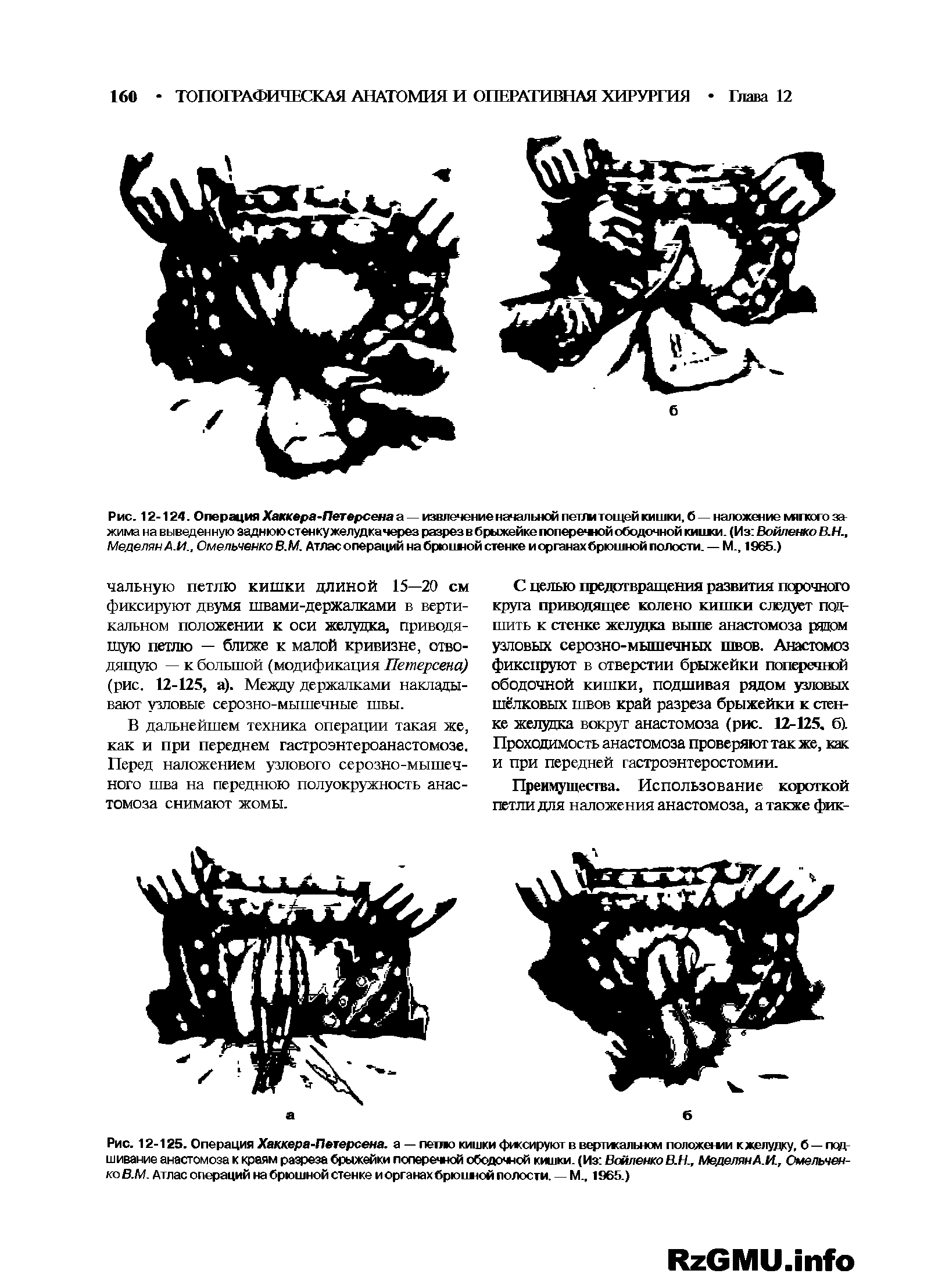 Рис. 12-124. Операция Хаккера-Петерсена а — извлечение начальной петтштощей кишки, б — наложение мягкого зажима на выведенную эаднююстенкужелудкачерез разрез в брыжейке поперечюй ободочной кийки. (Из Войлежо В.Н., Меделям А.И., Омельченко В.М. Атлас операций набрюивюй стенке иорганахбрюшной полости. — М., 1965.)...