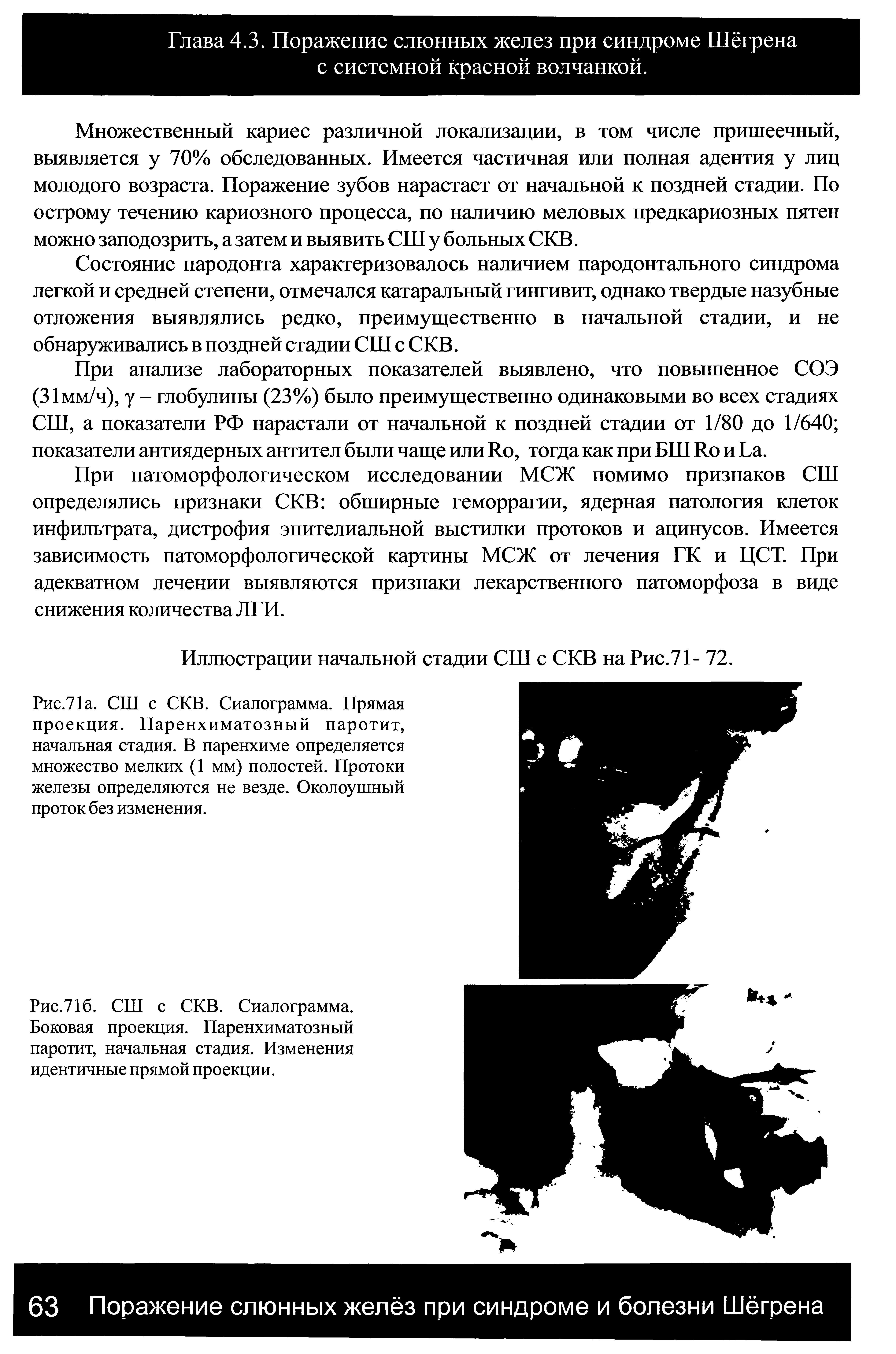 Рис.716. СШ с СКВ. Сиалограмма. Боковая проекция. Паренхиматозный паротит, начальная стадия. Изменения идентичные прямой проекции.