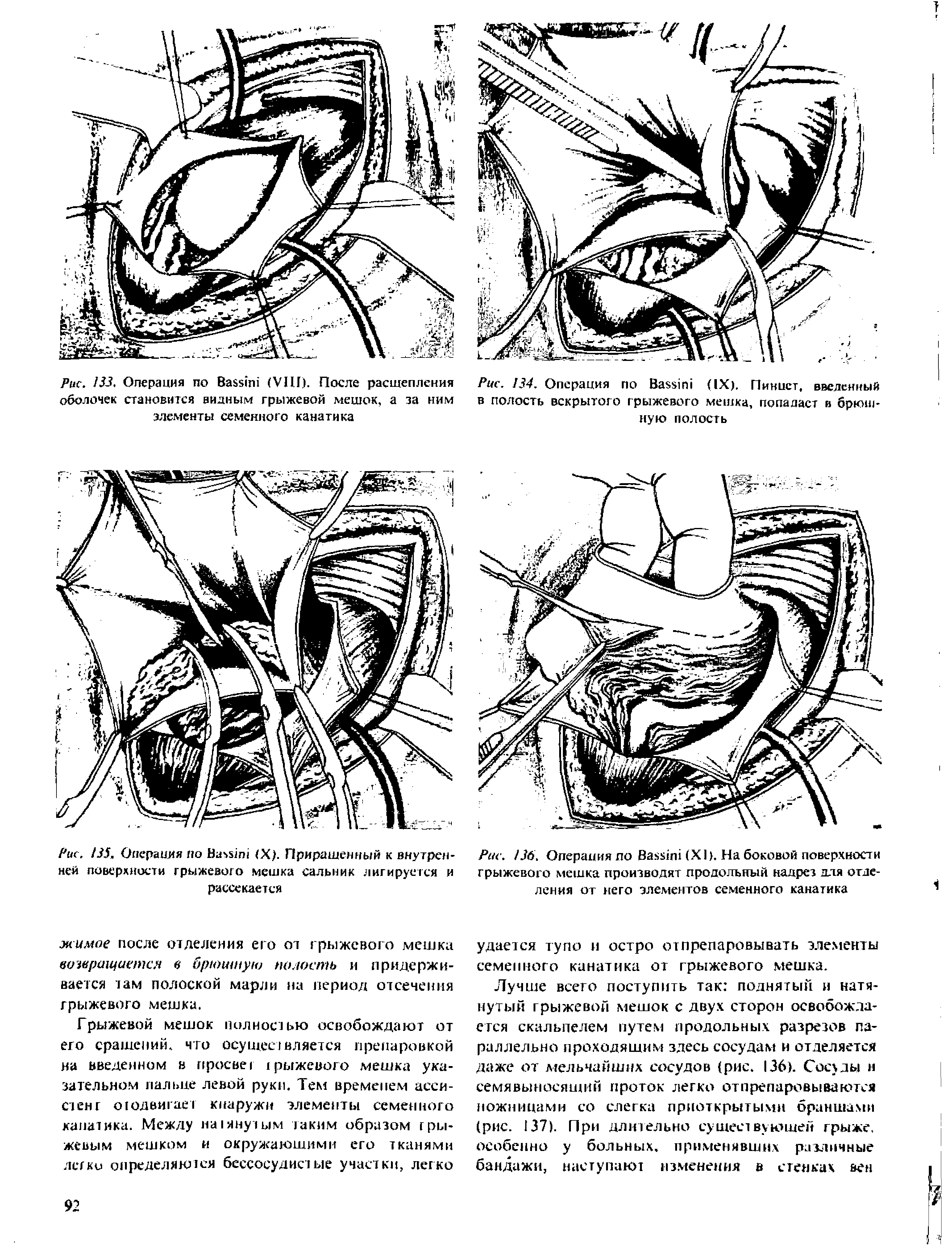 Рис. /35. Операция по B (X). Приращенный к внутренней поверхности грыжевого мешка сальник лигируется и рассекается...