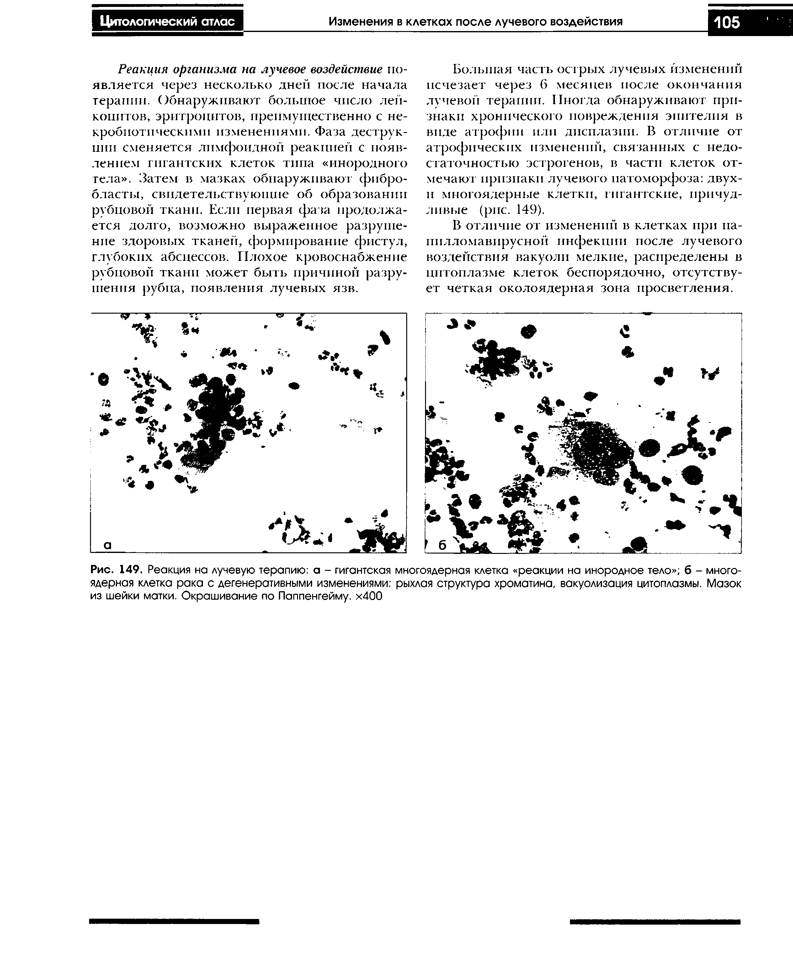 Рис. 149. Реакция на лучевую терапию а - гигантская многоядерная клетка реакции на инородное тело б - многоядерная клетка рака с дегенеративными изменениями рыхлая структура хроматина, вакуолизация цитоплазмы. Мазок из шейки матки. Окрашивание по Паппенгейму. х400...