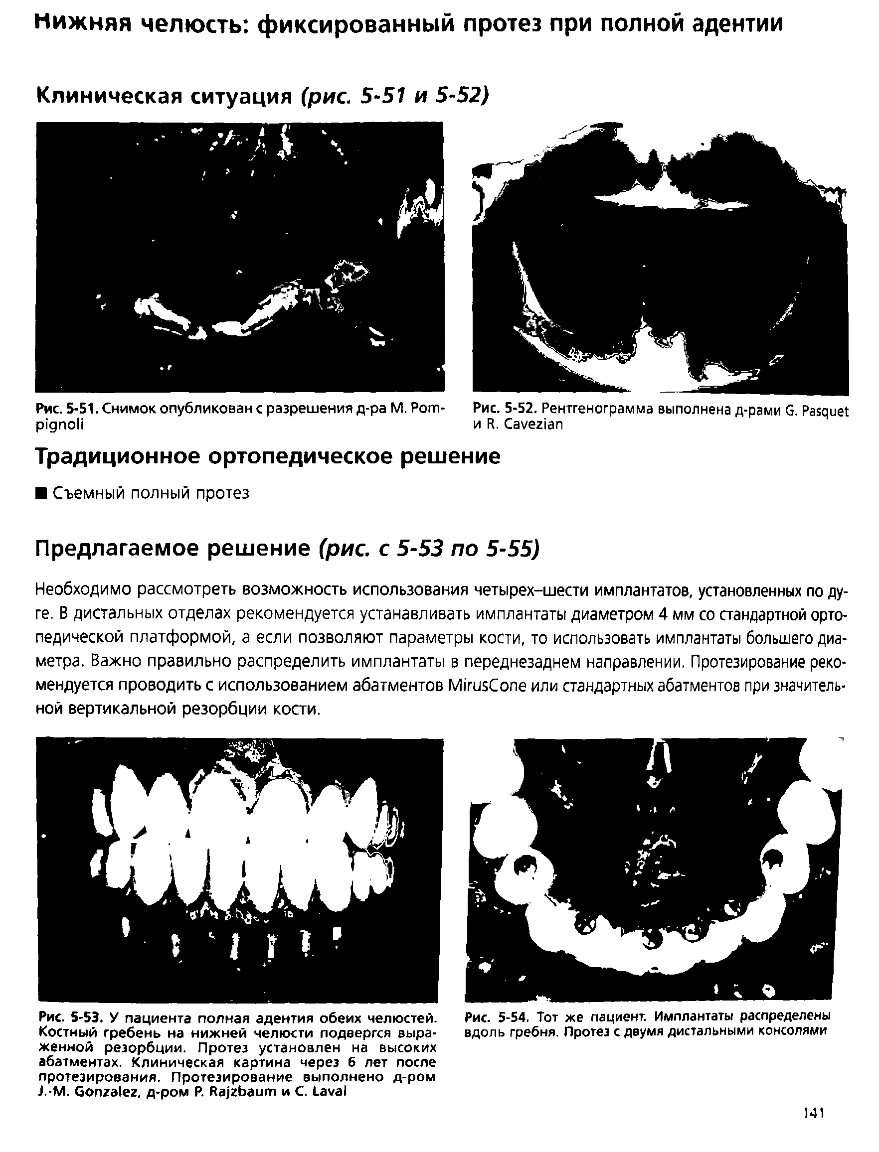 Рис. 5-53. У пациента полная адентия обеих челюстей. Костный гребень на нижней челюсти подвергся выраженной резорбции. Протез установлен на высоких абатментах. Клиническая картина через 6 лет после протезирования. Протезирование выполнено д-ром J.-M. G , д-ром P. R и С. L ...