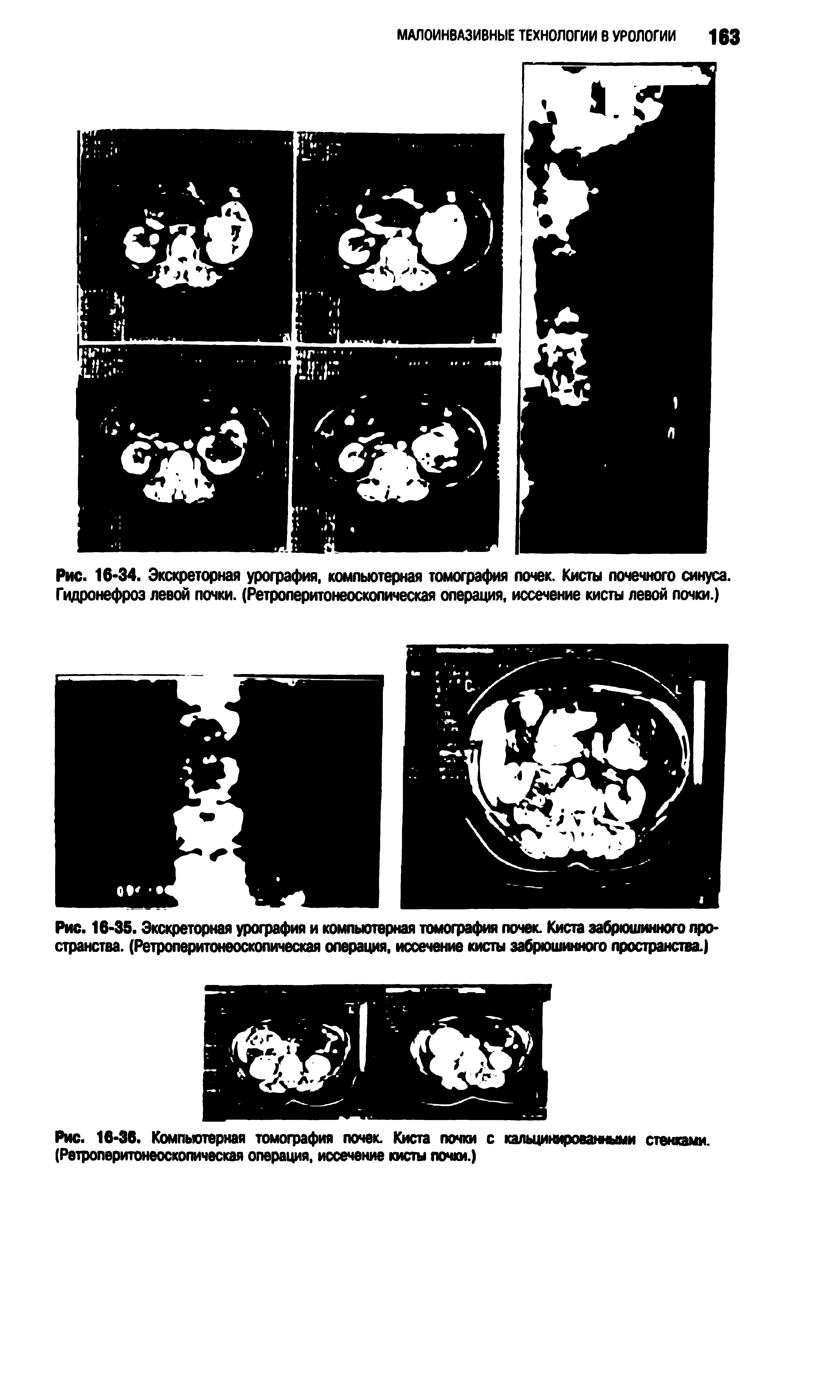 Рис. 16-34. Экскреторная урография, компьютерная томография почек. Кисты почечного синуса. Гидронефроз левой почки. (Ретролеритонеосколическая операция, иссечение кисты левой почки.)...