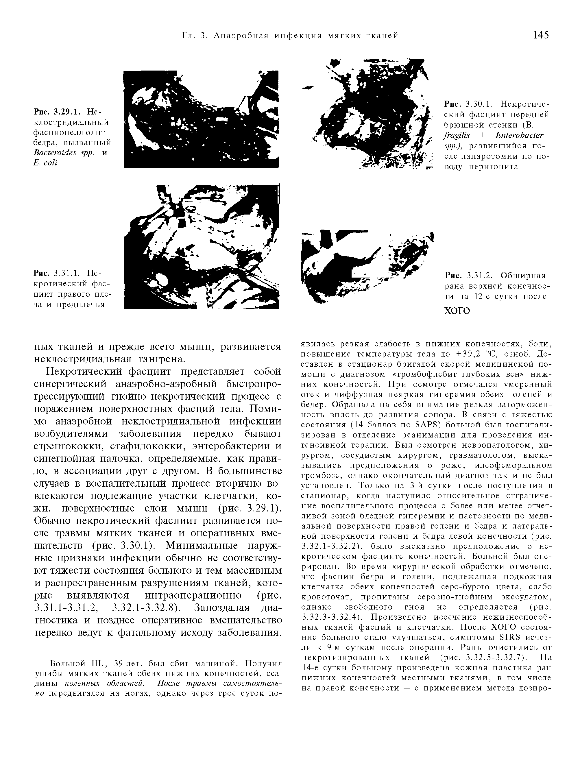 Рис. 3.30.1. Некротический фасциит передней брюшной стенки (В. + E .), развившийся после лапаротомии по поводу перитонита...