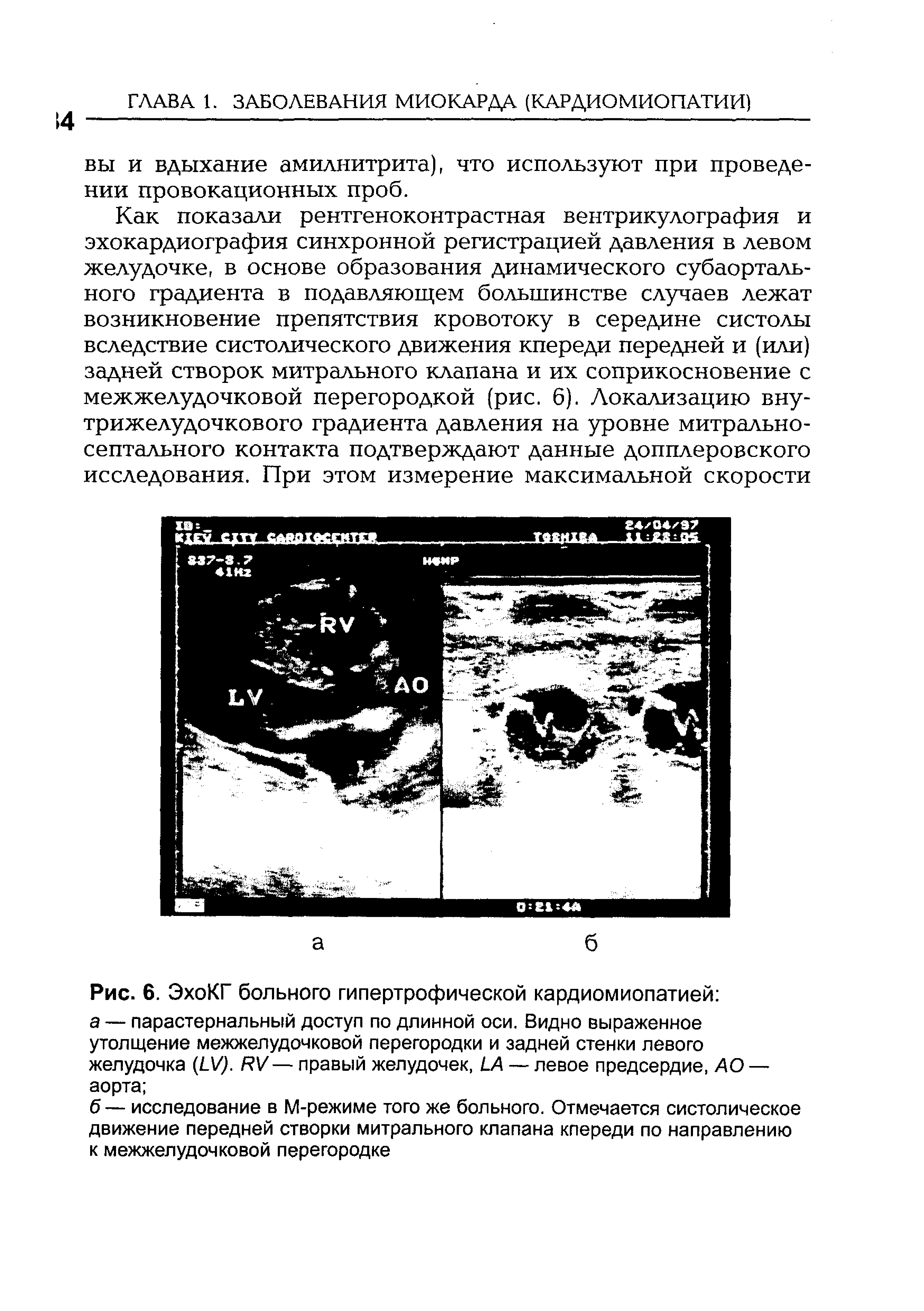 Рис. 6. ЭхоКГ больного гипертрофической кардиомиопатией а — парастернальный доступ по длинной оси. Видно выраженное утолщение межжелудочковой перегородки и задней стенки левого желудочка (ГУ/ КУ— правый желудочек, М — левое предсердие, АО — аорта ...