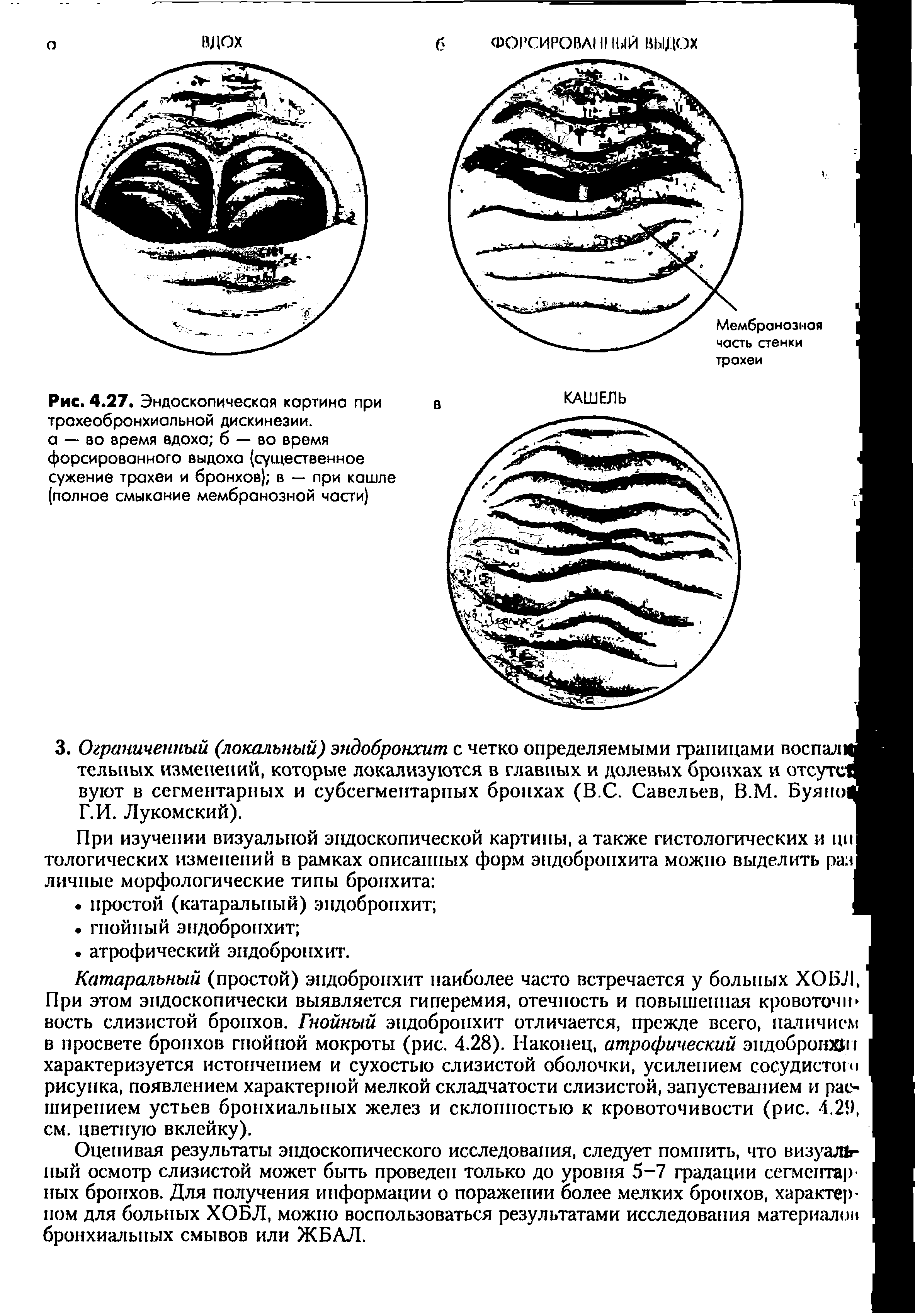 Рис. 4.27. Эндоскопическая картина при трахеобронхиальной дискинезии, а — во время вдоха б — во время форсированного выдоха (существенное сужение трахеи и бронхов) в — при кашле (полное смыкание мембранозной части)...