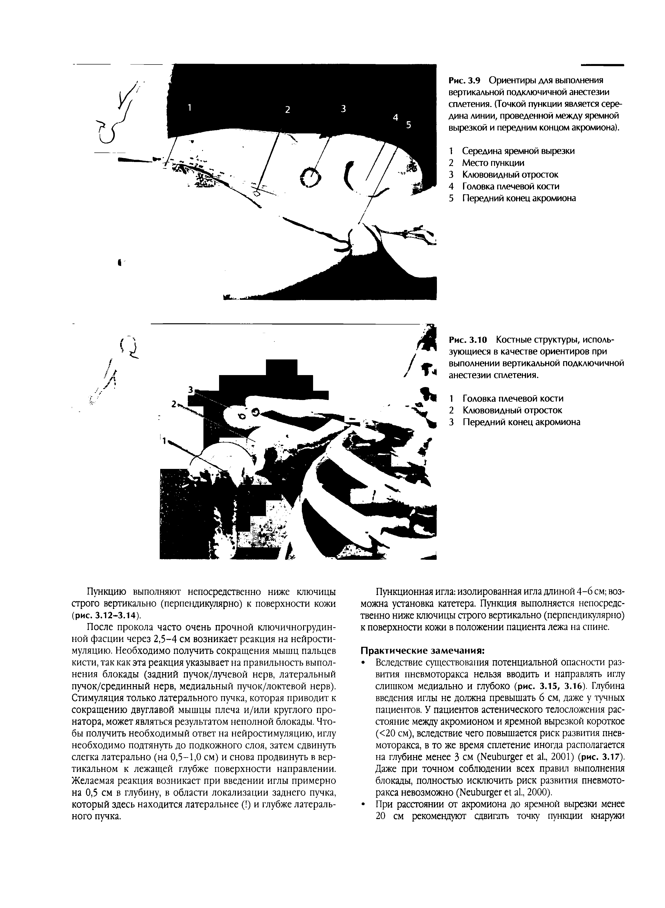 Рис. 3.10 Костные структуры, использующиеся в качестве ориентиров при выполнении вертикальной подключичной анестезии сплетения.