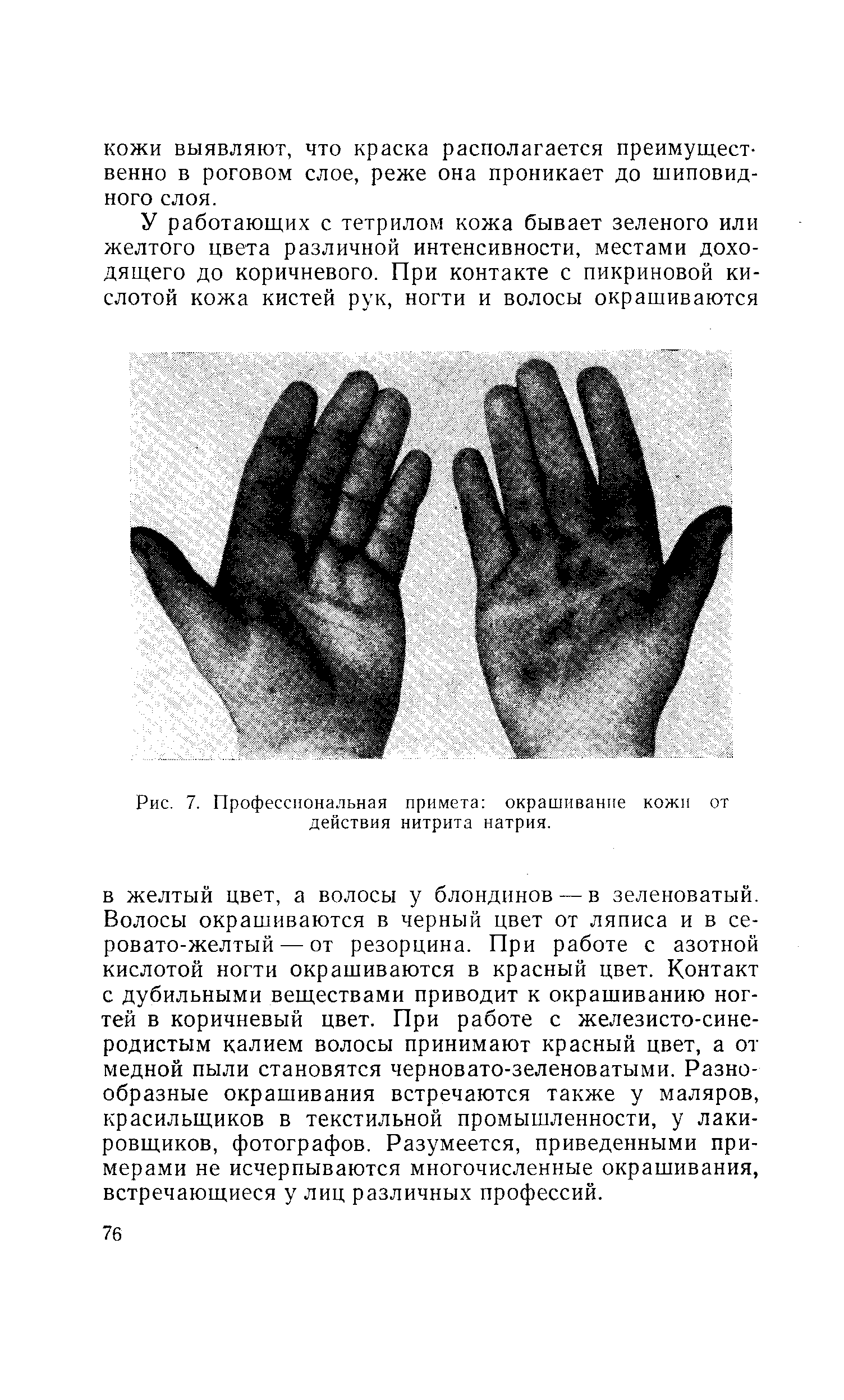 Рис. 7. Профессиональная примета окрашивание кожи от действия нитрита натрия.