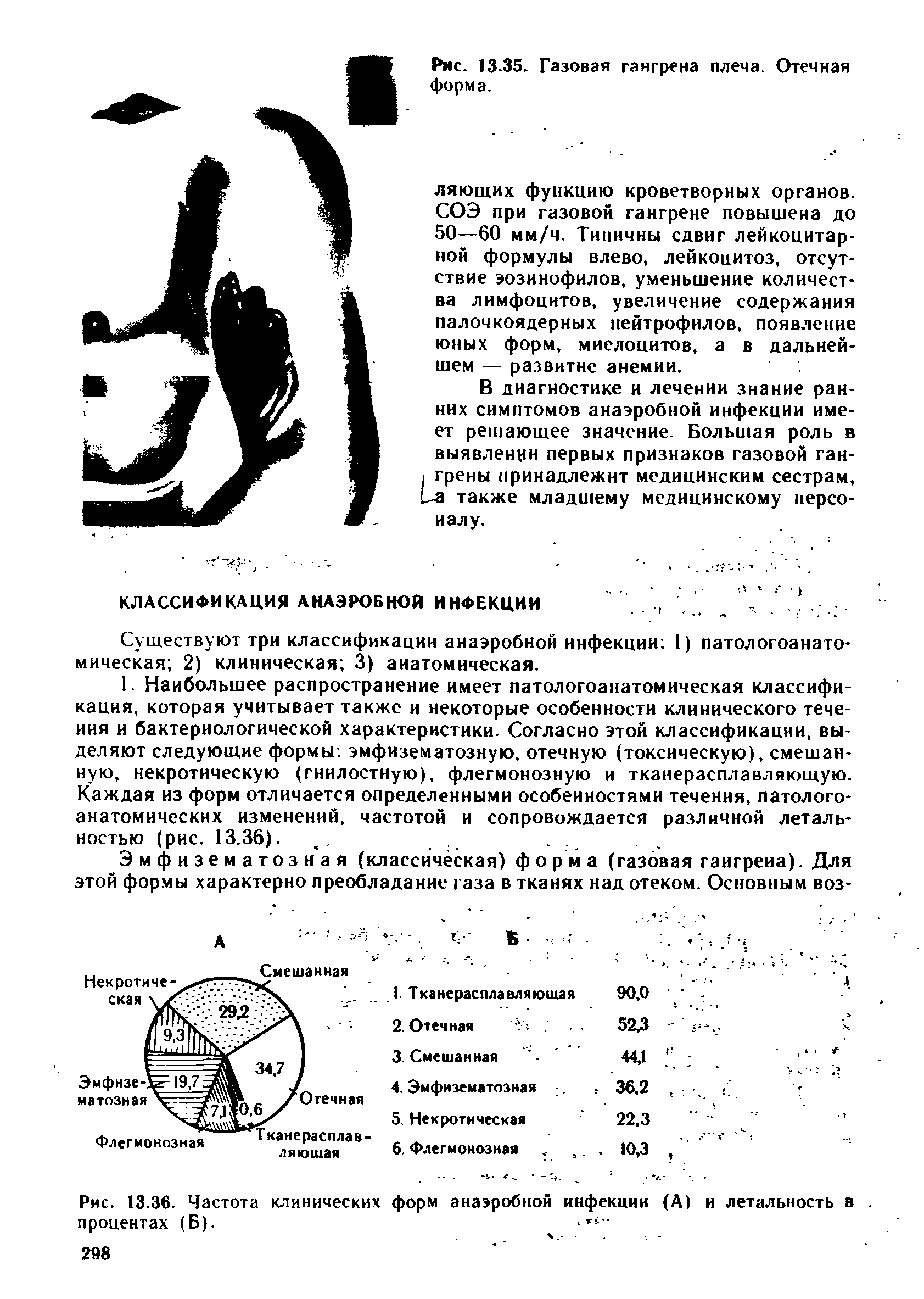 Рис. 13.36. Частота клинических форм анаэробной инфекции (А) и летальность в. процентах (Б).