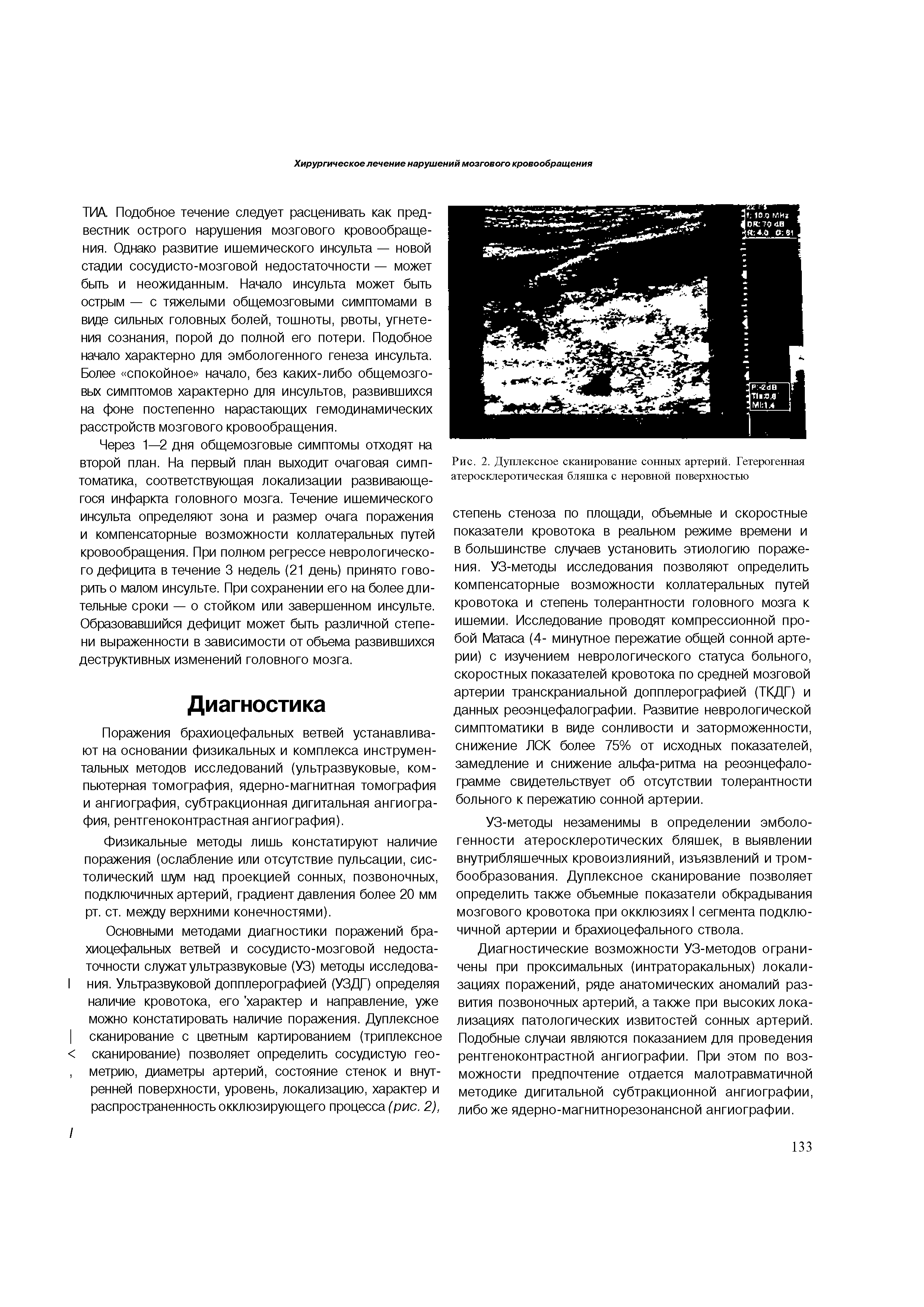 Рис. 2. Дуплексное сканирование сонных артерий. Гетерогенная атеросклеротическая бляшка с неровной поверхностью...