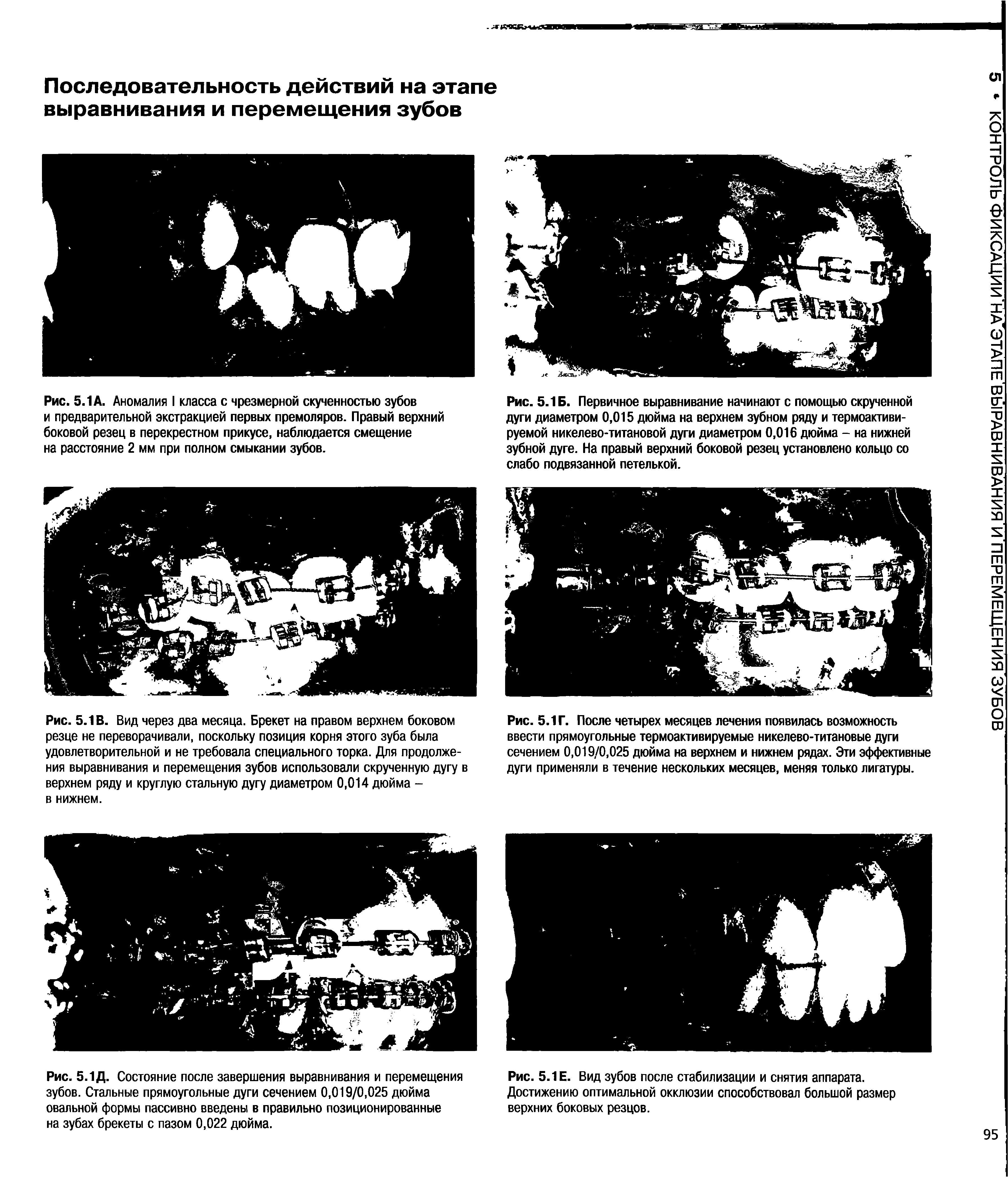 Рис. 5.1 А. Аномалия I класса с чрезмерной скученностью зубов и предварительной экстракцией первых премоляров. Правый верхний боковой резец в перекрестном прикусе, наблюдается смещение на расстояние 2 мм при полном смыкании зубов.