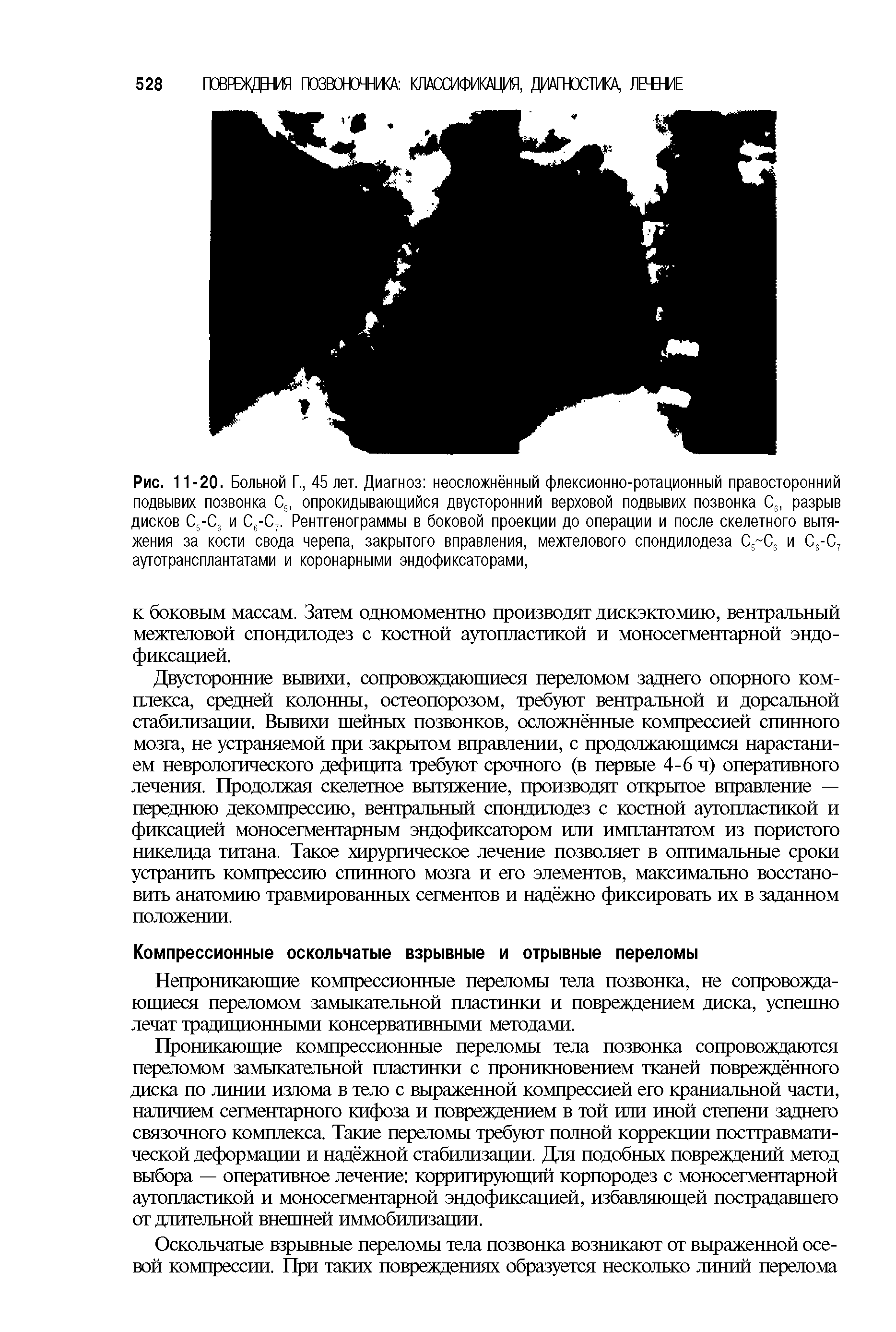 Рис. 11-20. Больной Г., 45 лет. Диагноз неосложнённый флексионно-ротационный правосторонний подвывих позвонка С5, опрокидывающийся двусторонний верховой подвывих позвонка С6, разрыв дисков С5-С6 и С6-С7. Рентгенограммы в боковой проекции до операции и после скелетного вытяжения за кости свода черепа, закрытого вправления, межтелового спондилодеза С С6 и С6-С7 аутотрансплантатами и коронарными эндофиксаторами,...