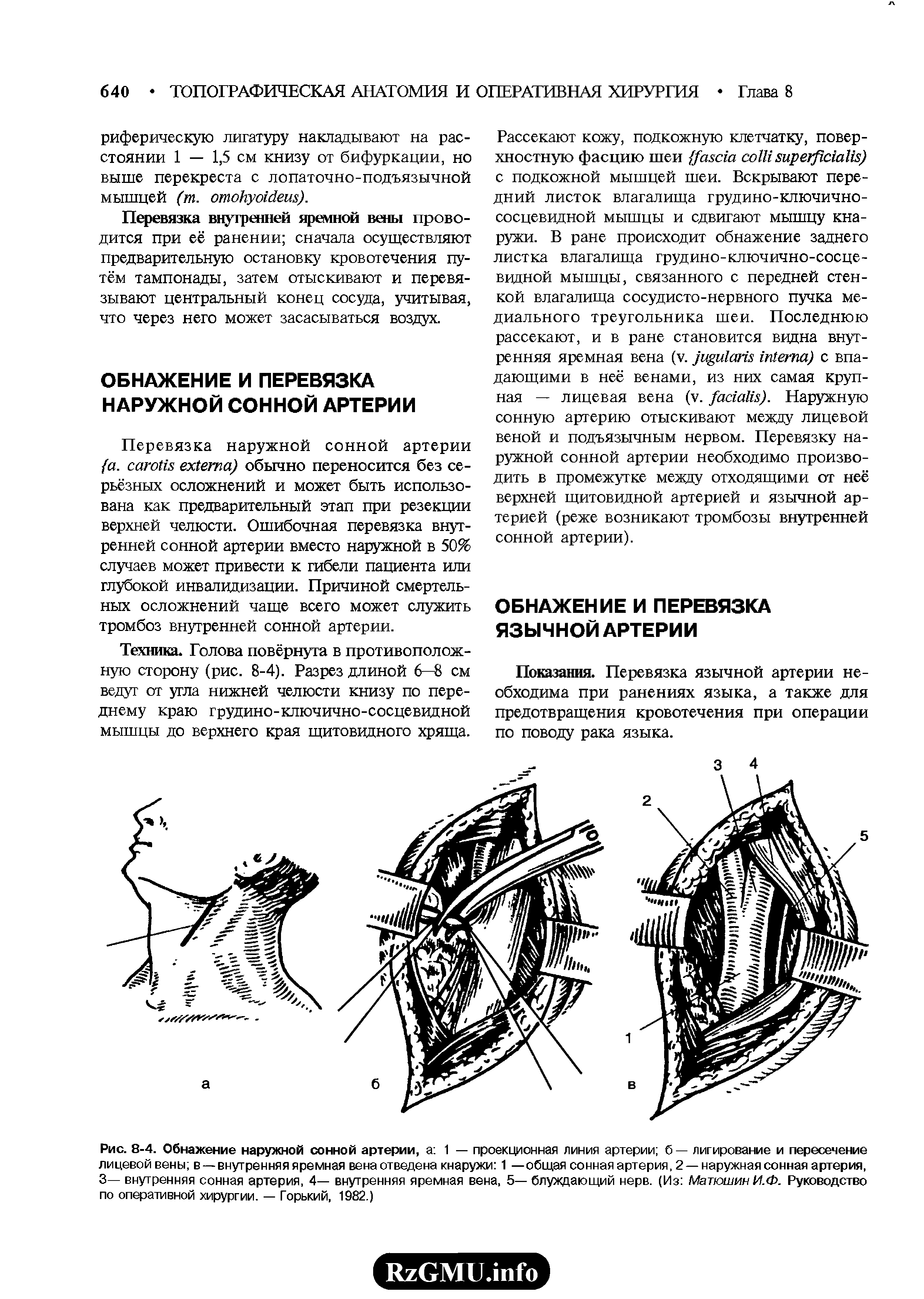 Рис. 8-4. Обнажение наружной сонной артерии, а 1 — проекционная линия артерии б — лигирование и пересечение лицевой вены в —внутренняя яремная вена отведена кнаружи 1 —общая сонная артерия, 2 —наружная сонная артерия, 3— внутренняя сонная артерия, 4— внутренняя яремная вена, 5— блуждающий нерв. (Из Матюшин И.Ф. Руководство по оперативной хирургии. — Горький, 1982.)...