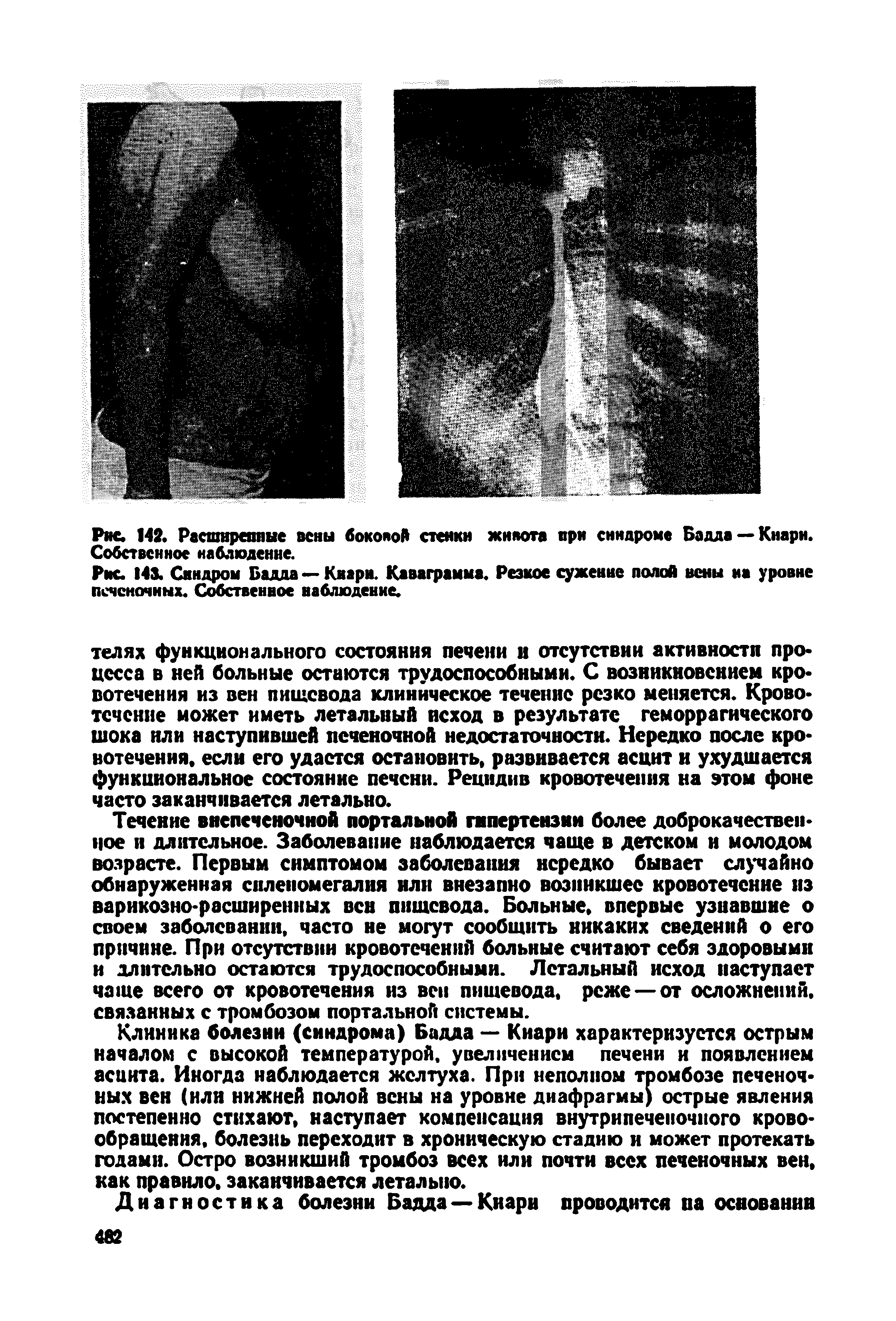 Рис. 143. Синдром Бадда —Киарн. Каваграмма. Резкое сужение полой вены на уровне печеночных. Собственное наблюдение.