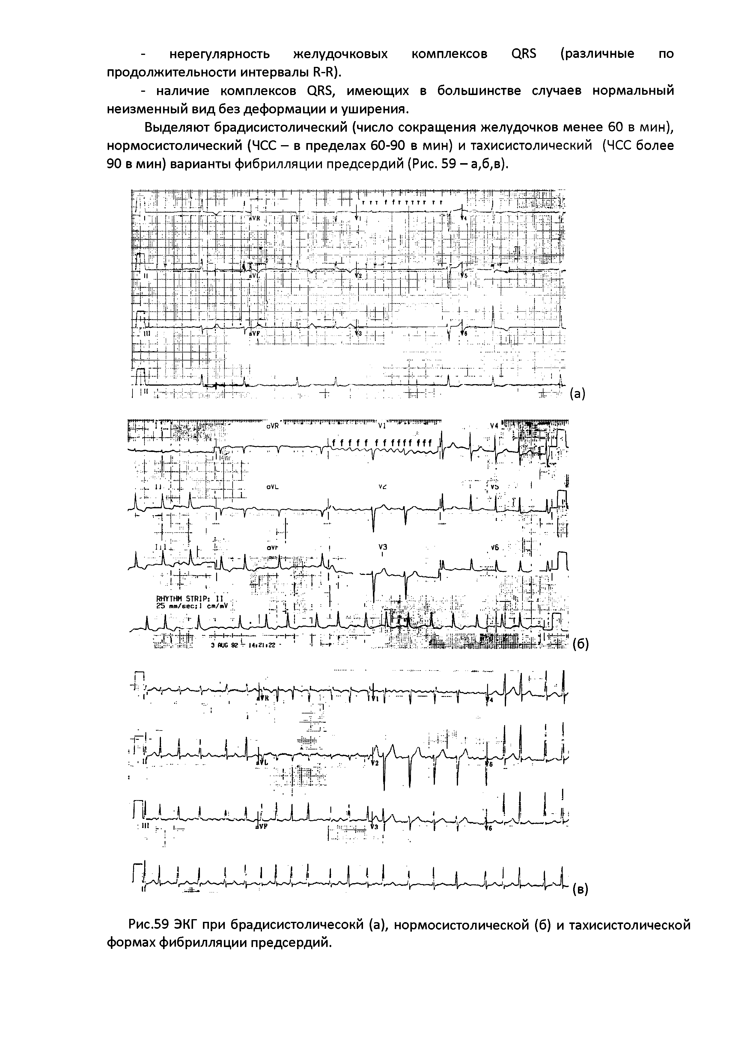 Рис.59 ЭКГ при брадисистоличесокй (а), нормосистолической (б) и тахисистолической формах фибрилляции предсердий.