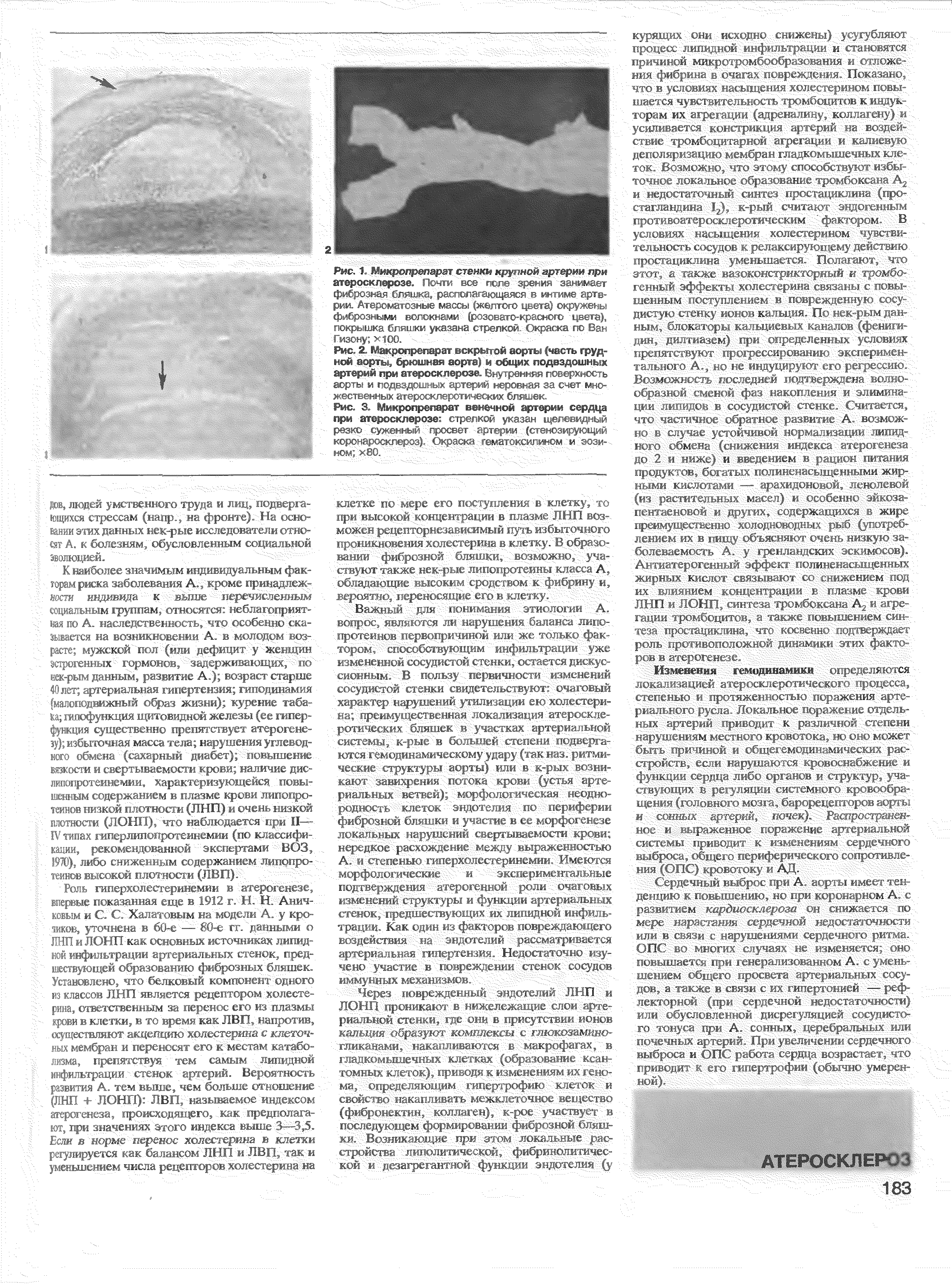 Рис. 2. Маиропрепарат вскрытой аорты (часть грудной аорты, брюшная аорта) и общих подвздошных артерий при атеросклерозе. Внутренняя поверхность аорты и подвздошных артерий неровная за счет множественных атеросклеротических бляшек.